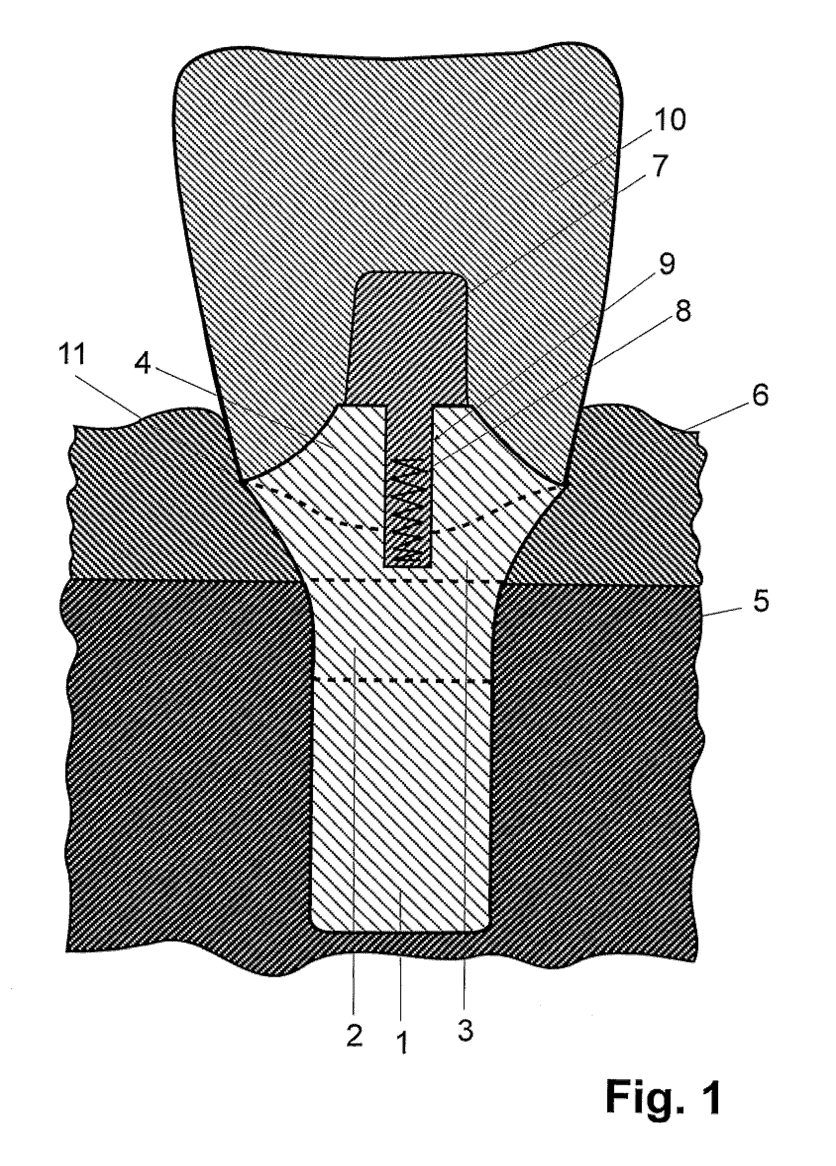 Dental Implant System