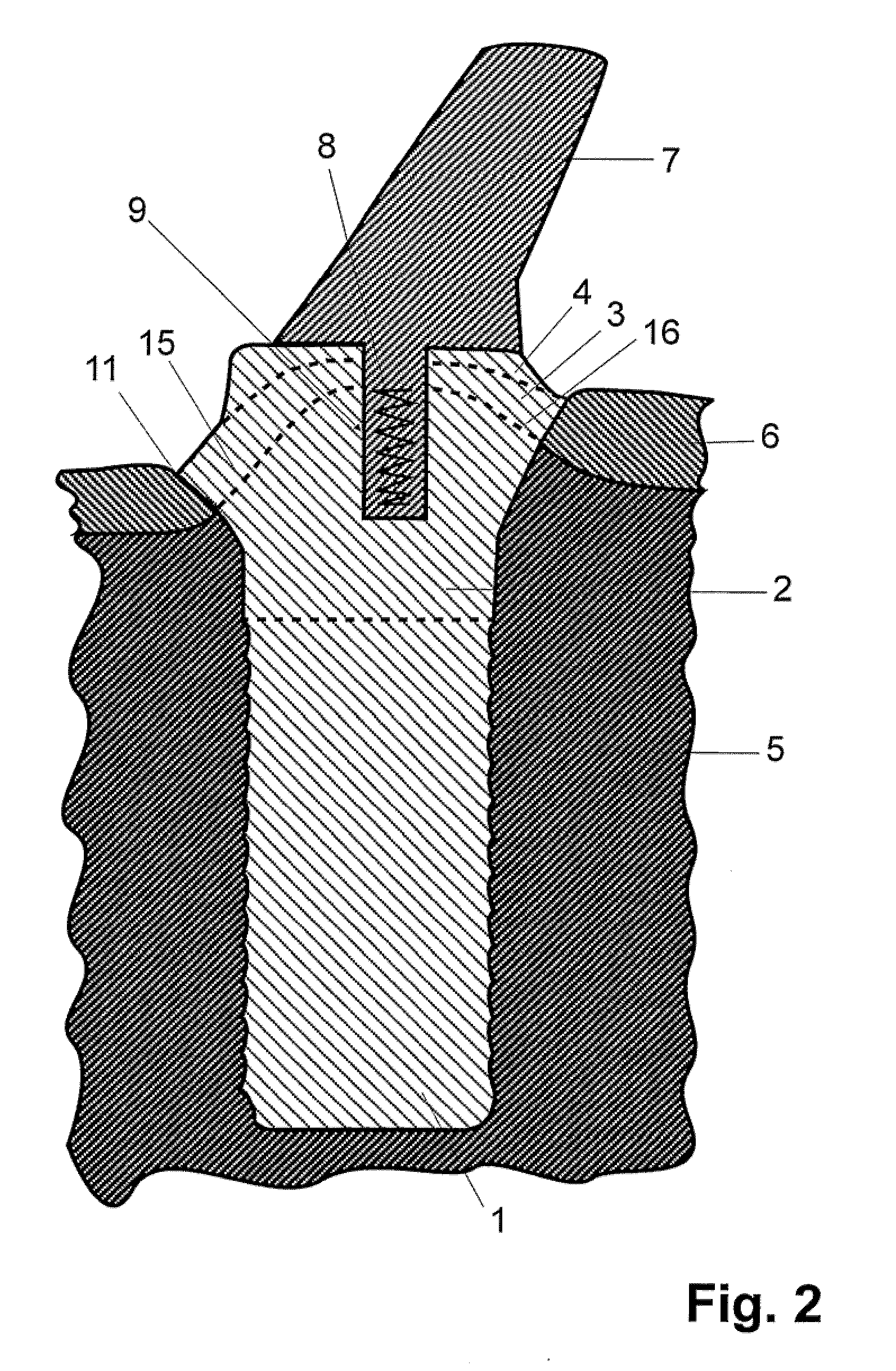 Dental Implant System