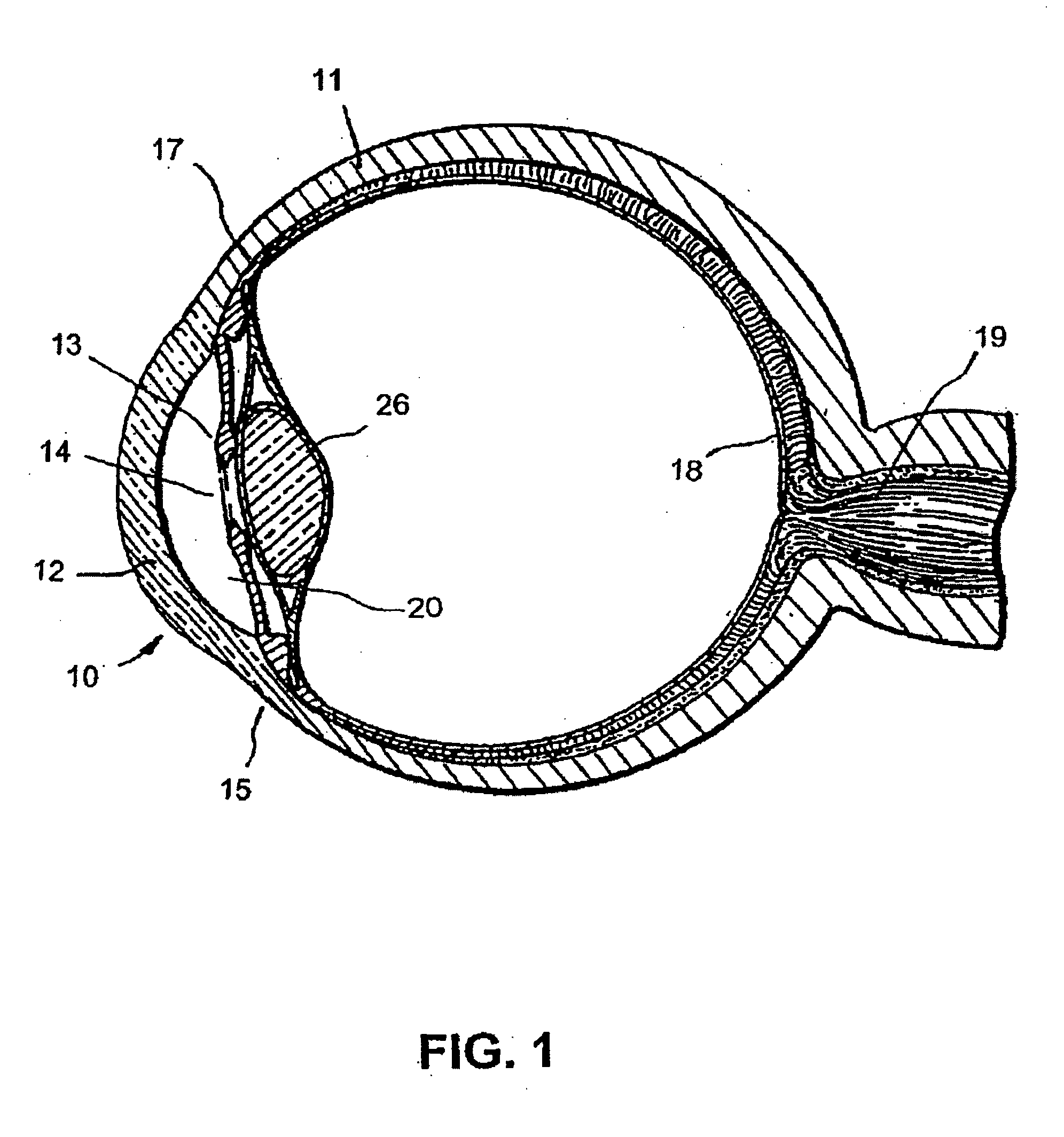 Glaucoma implant with extending members