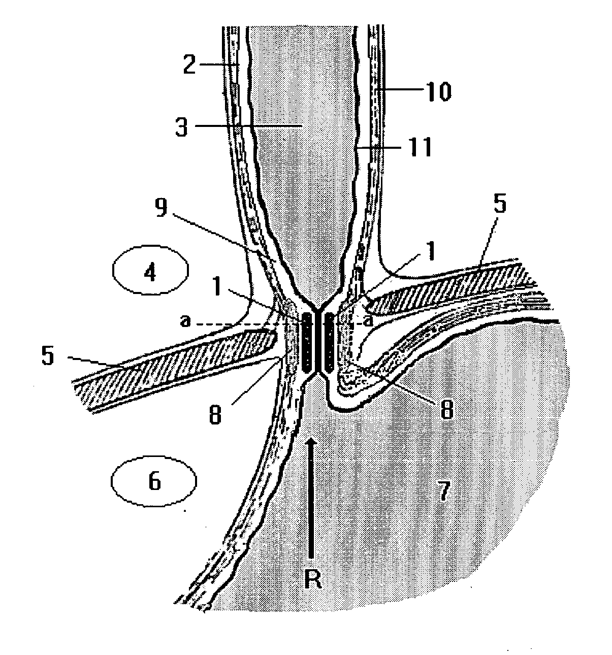 Magnetic device and method to prevent gastroesophageal reflux, fecal incontinence and urinary incontinence