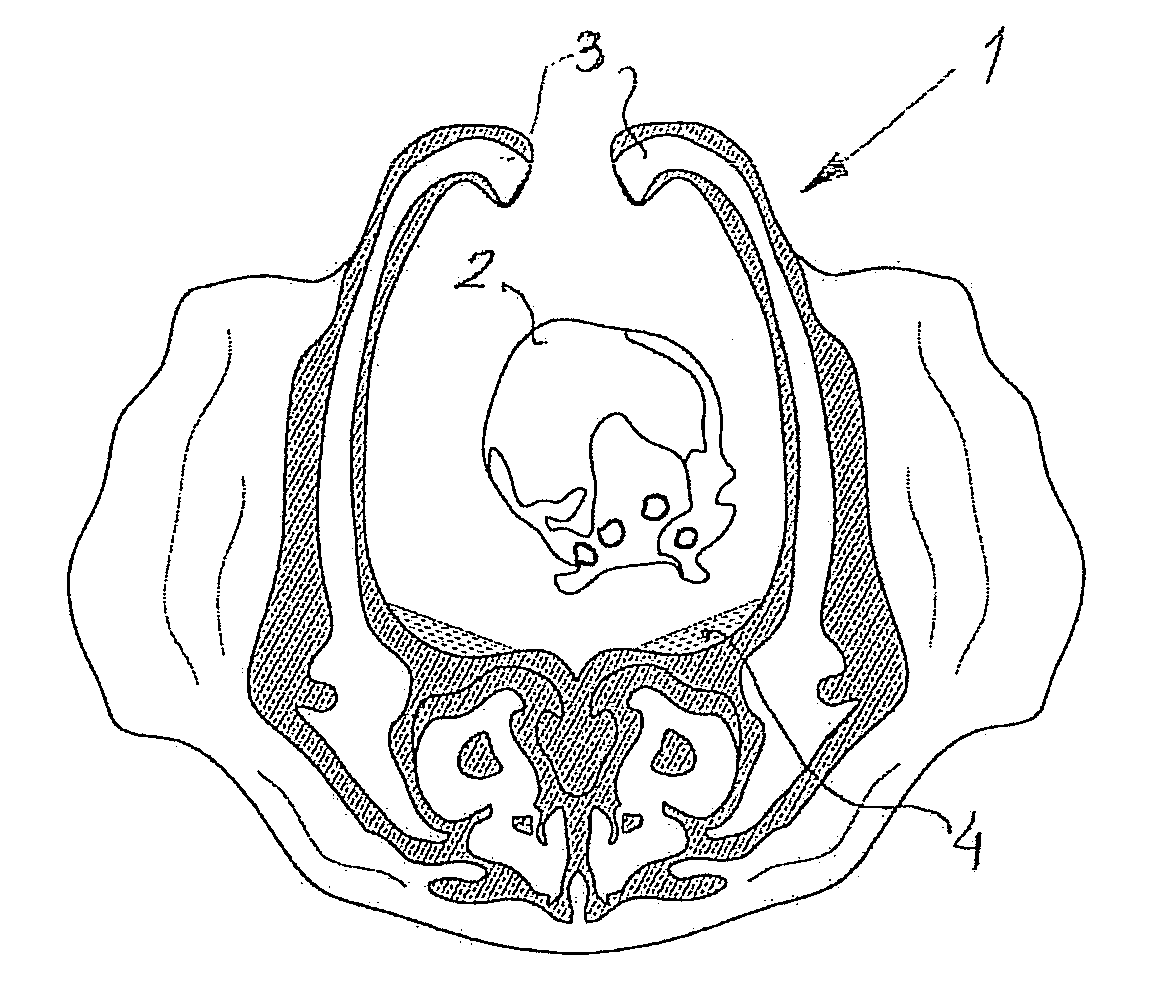 Surgical method