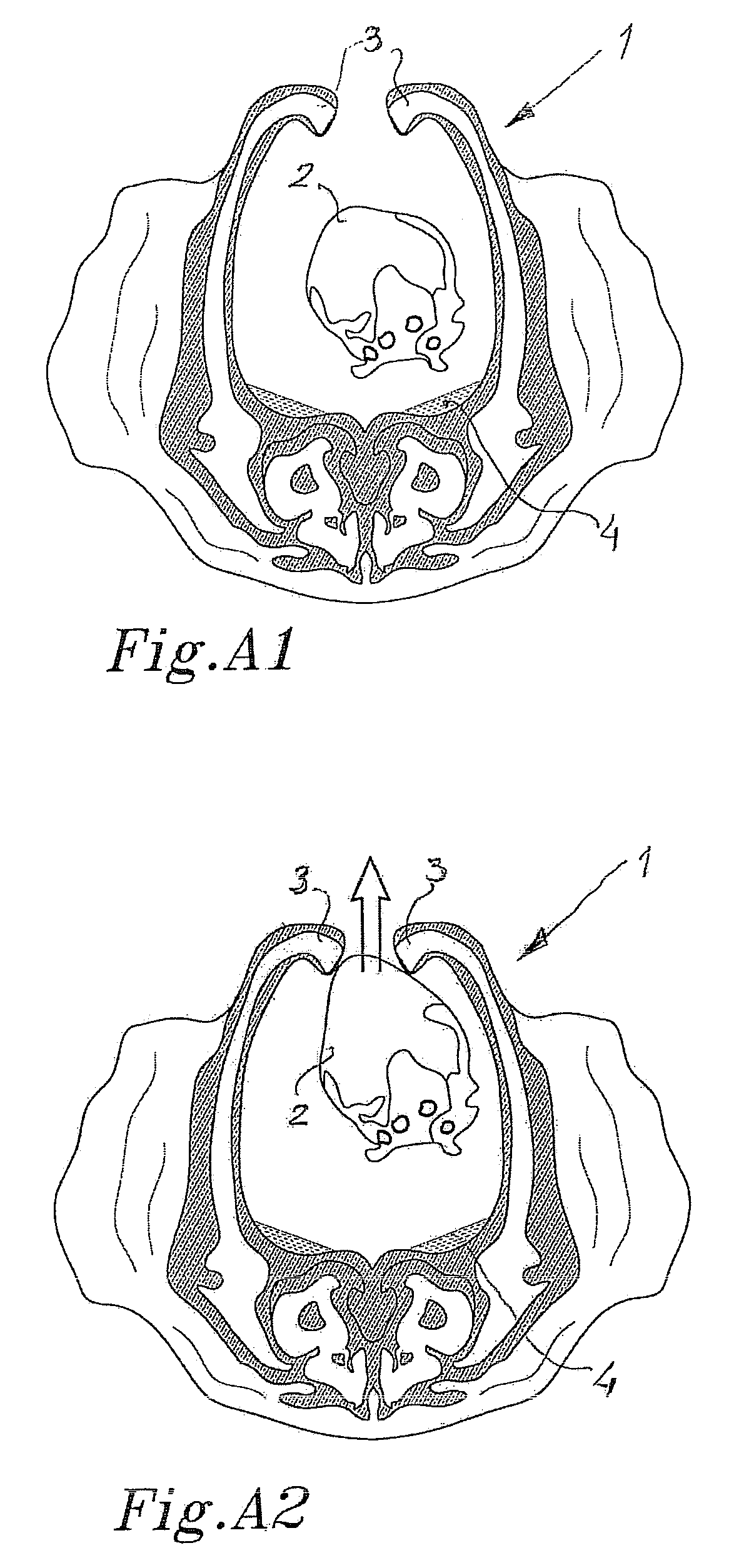 Surgical method