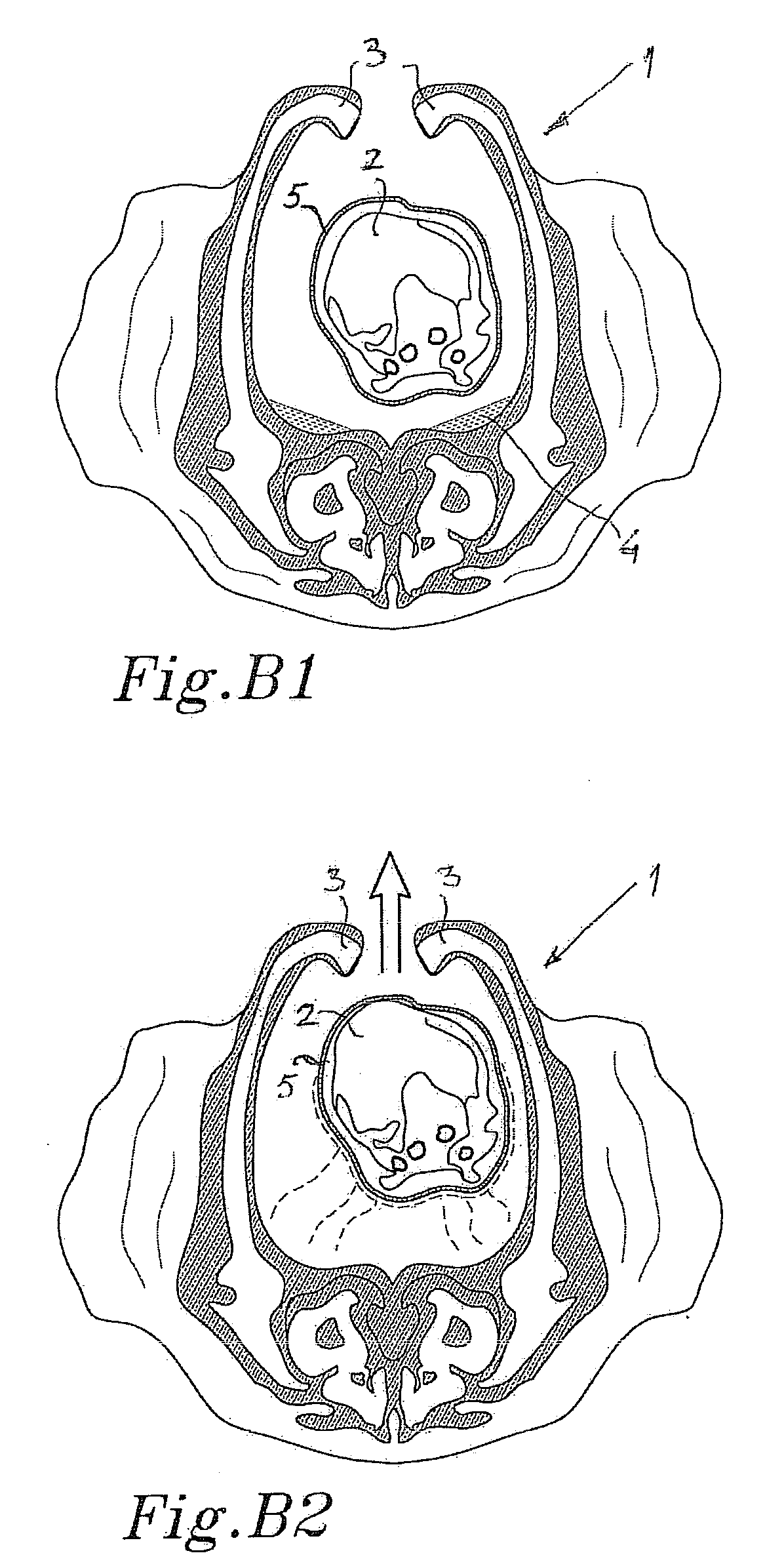 Surgical method