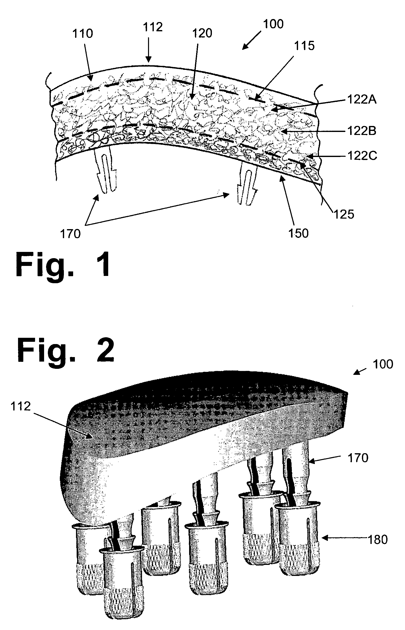 Hydrogel implants for replacing hyaline cartilage, with charged surfaces and improved anchoring