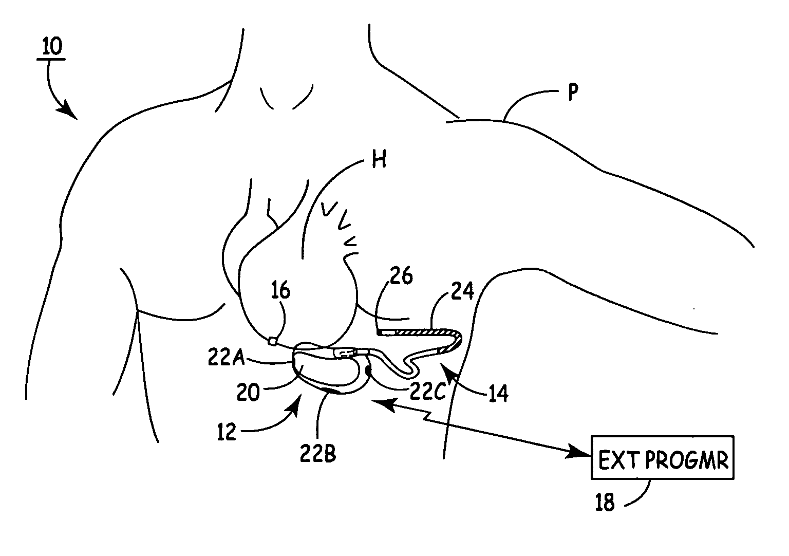 Subcutaneous ICD with separate cardiac rhythm sensor