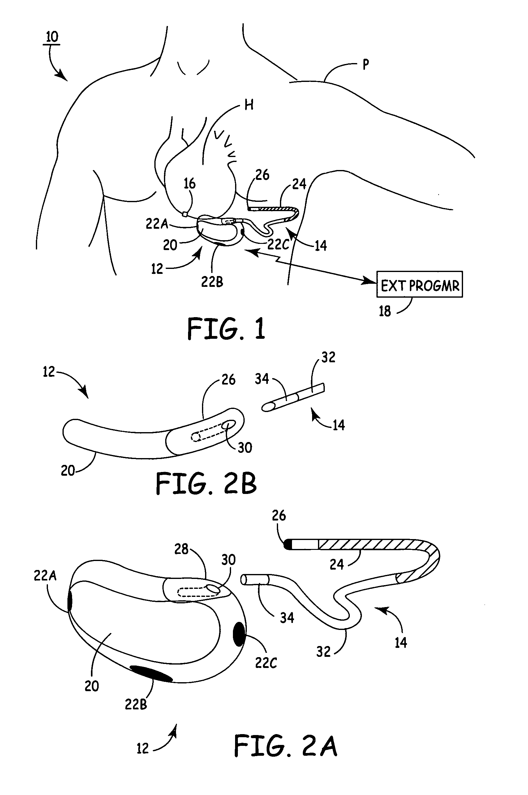 Subcutaneous ICD with separate cardiac rhythm sensor