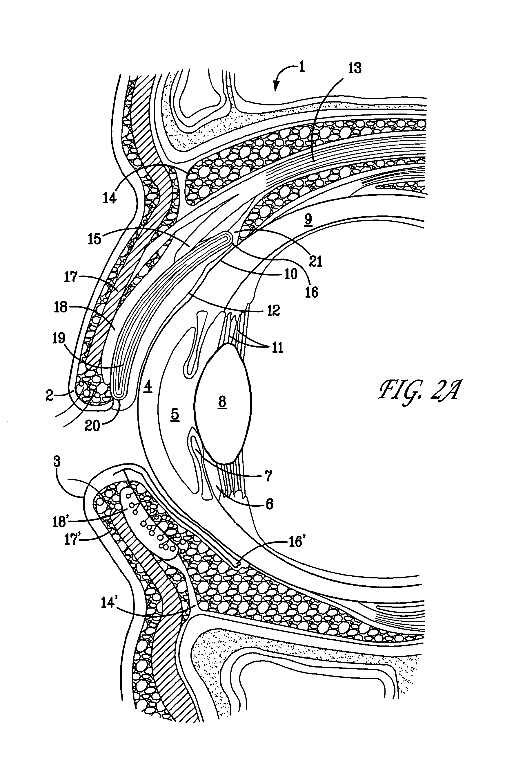 Surgical correction of ptosis by polymeric artificial muscles