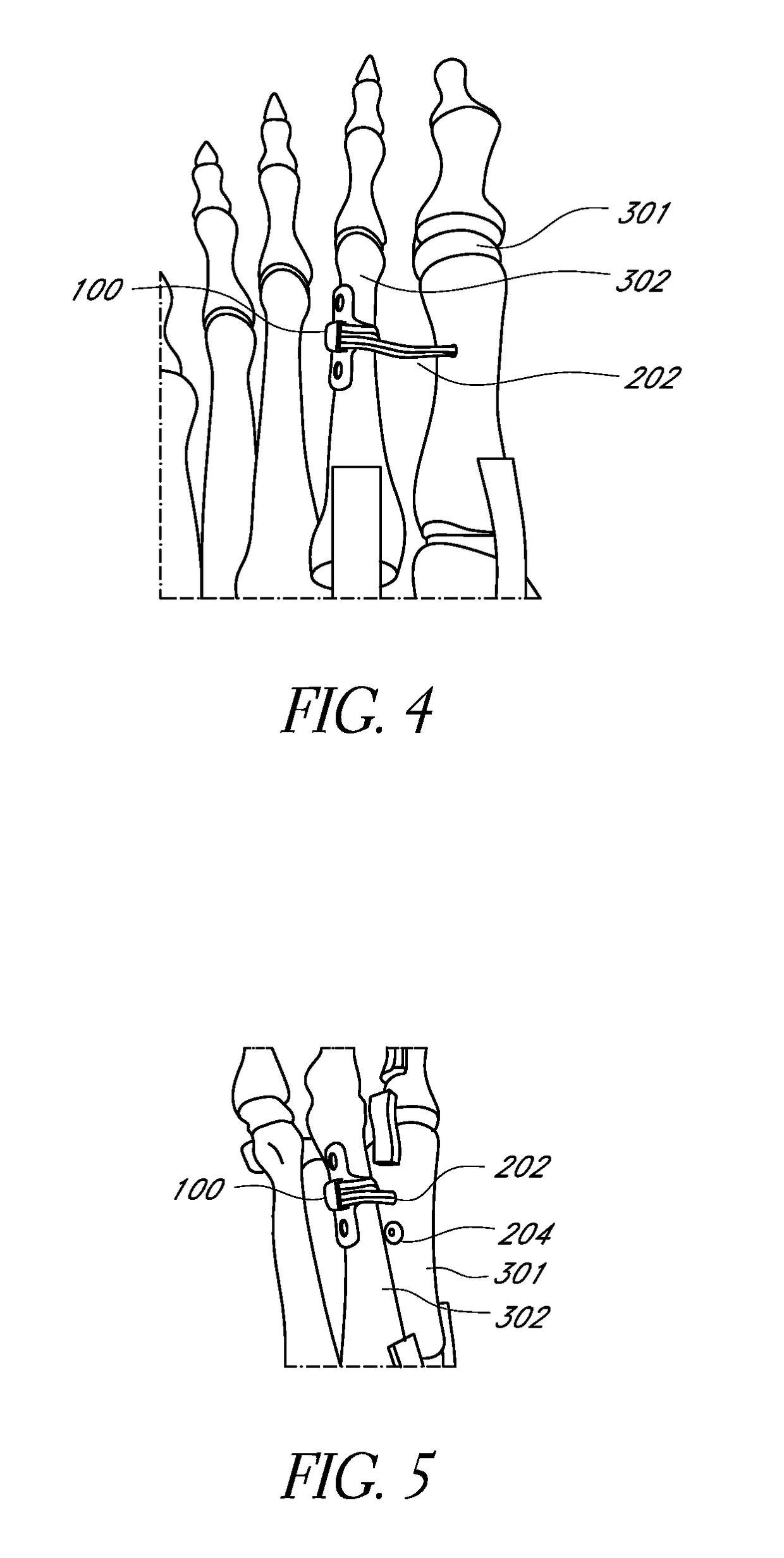 Bone plate for reducing angular bone deformity and method of using