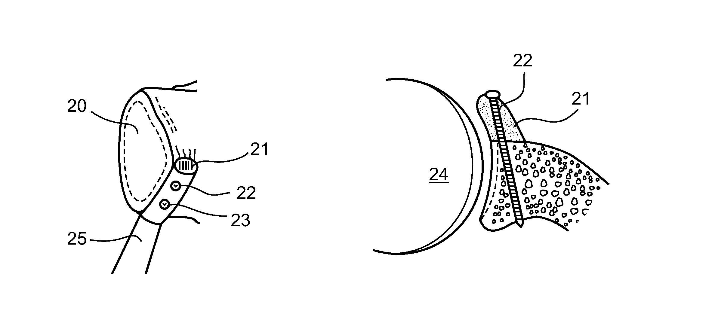 Arthroscopic bone transplanting procedure, and medical instruments useful therein