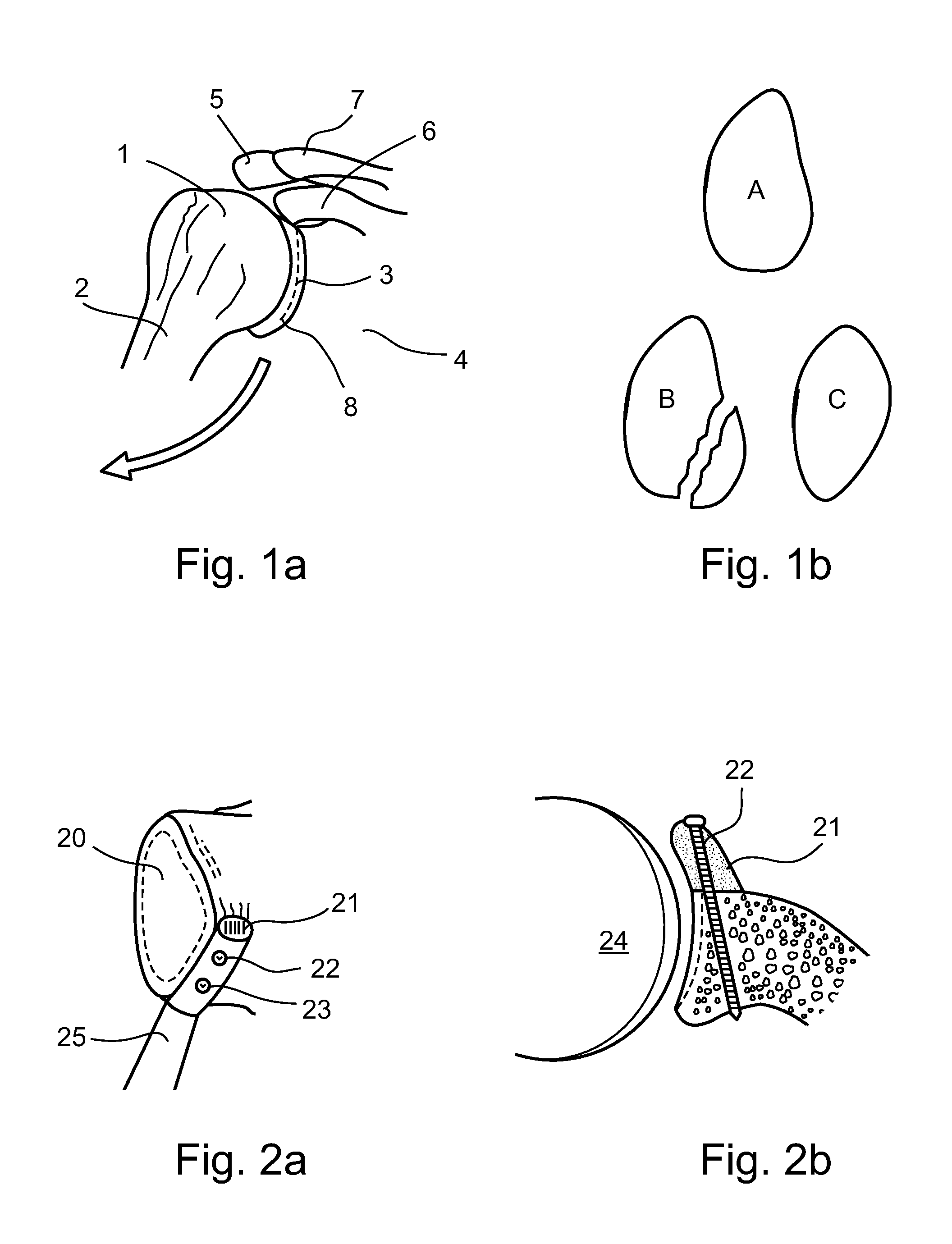 Arthroscopic bone transplanting procedure, and medical instruments useful therein