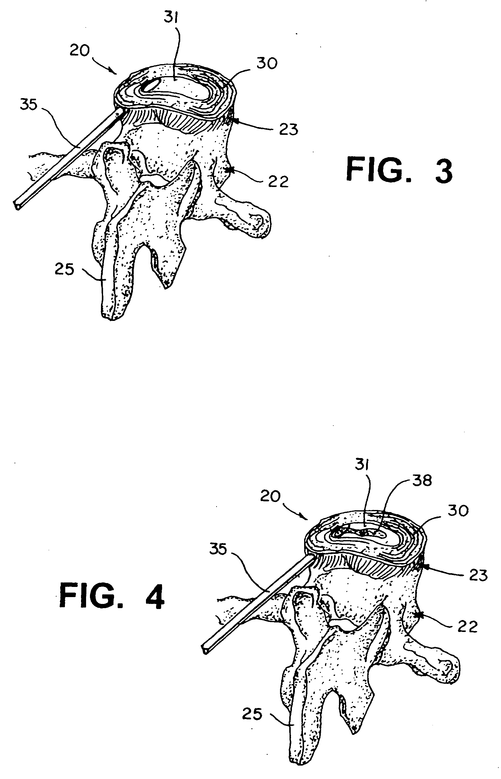 Method and compostion for repair and reconstruction of intervertebral discs and other reconstructive surgery