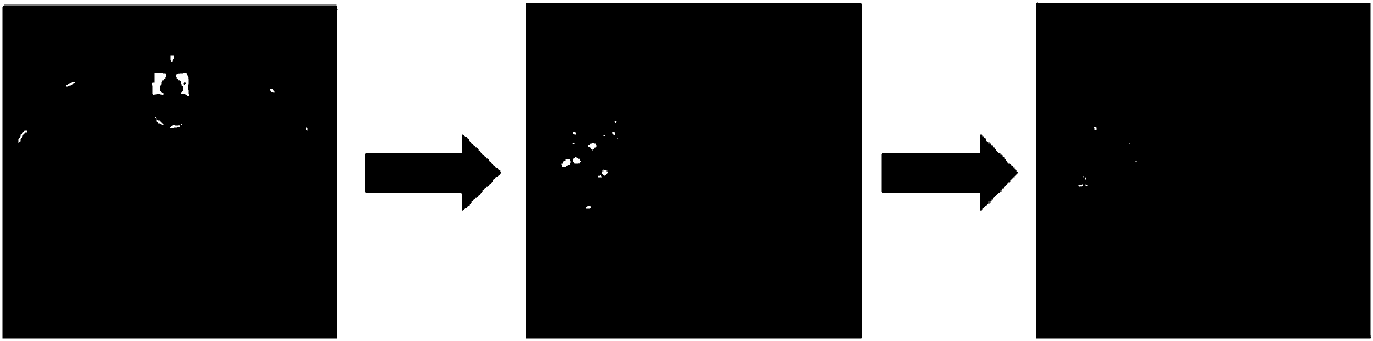 Liver cancer image automatic segmentation method based on random forest and fuzzy clustering