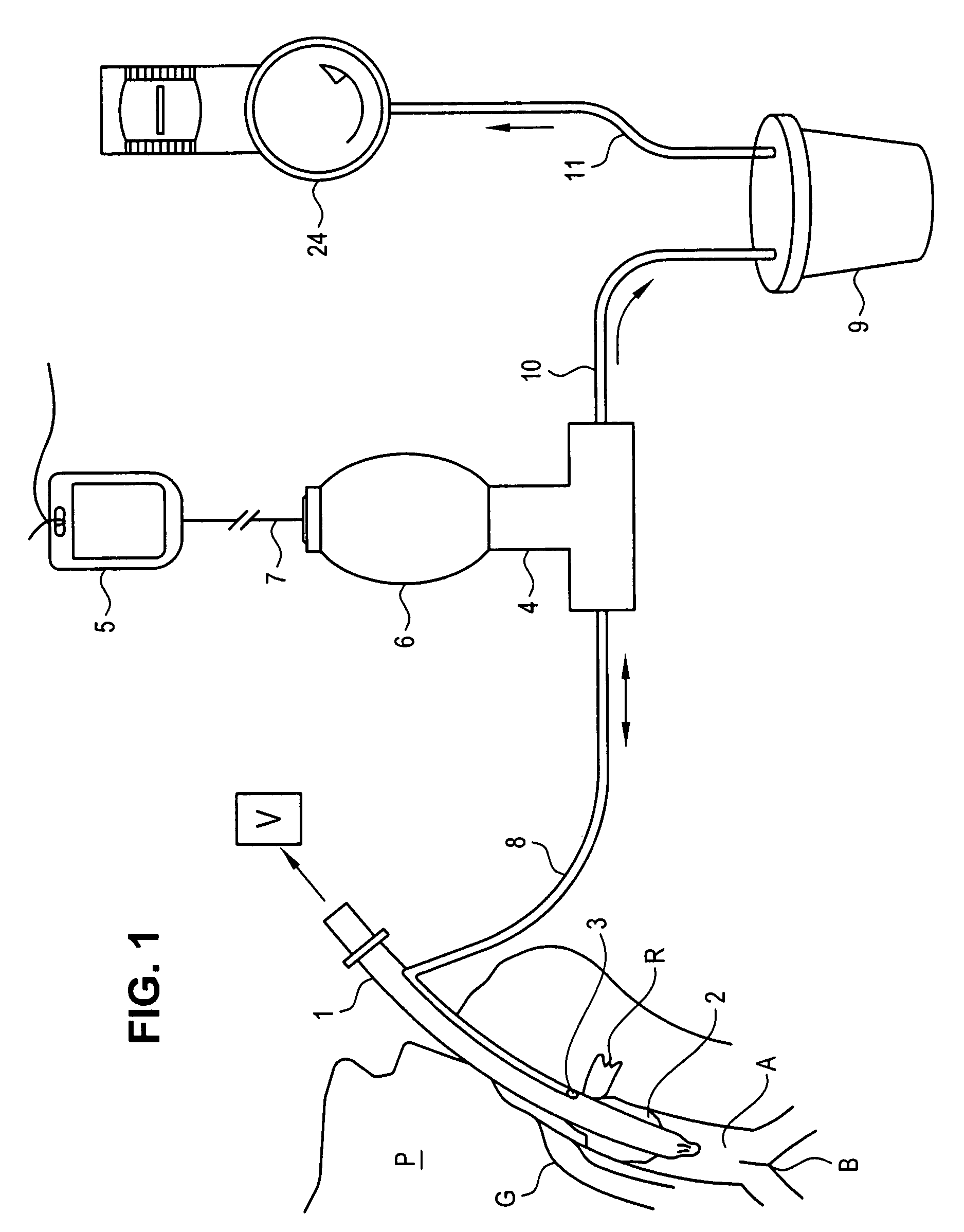 Apparatus for vacuum-assisted irrigation and drainage of a body cavity