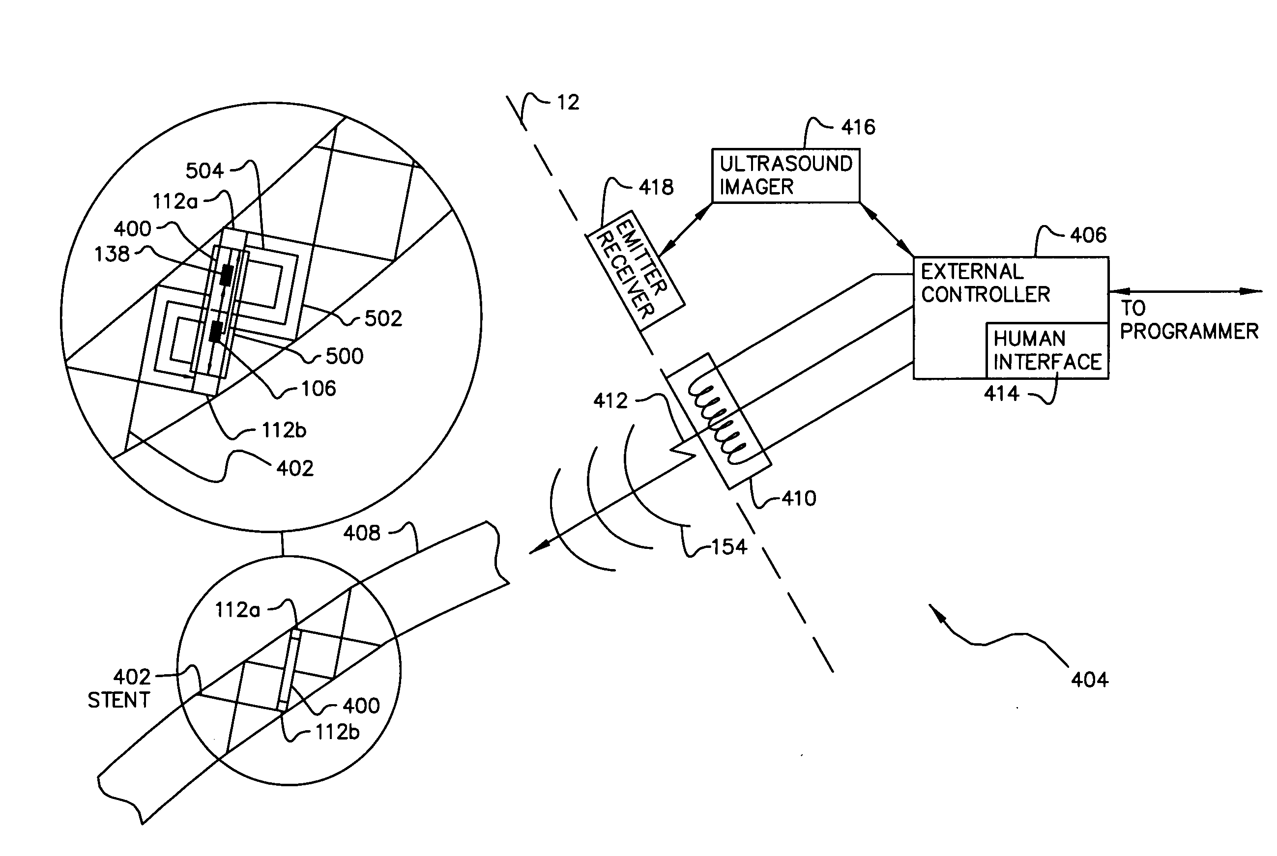 Stent having an integral ultrasonic emitter for preventing restenosis following a stent procedure