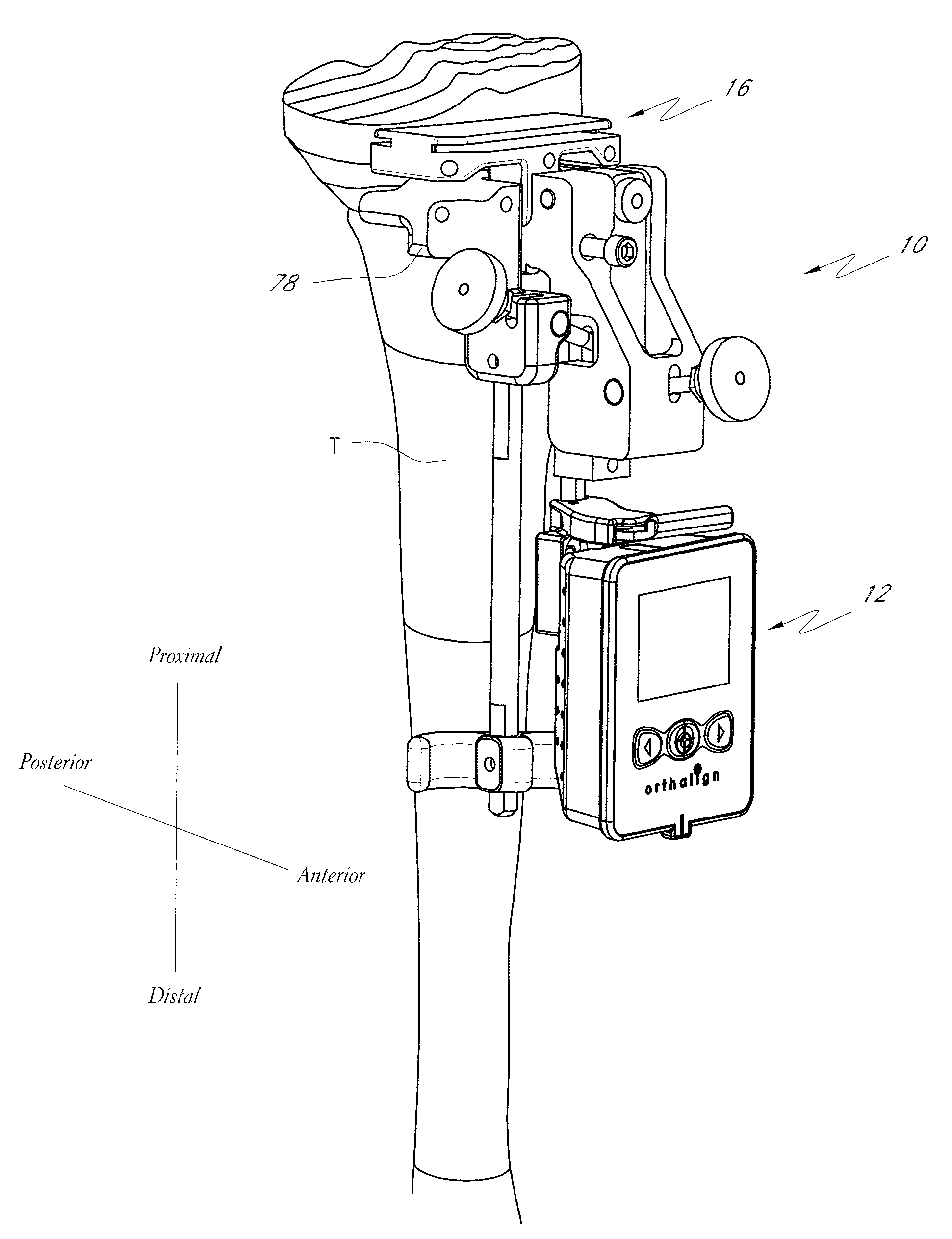 Systems and methods for joint replacement