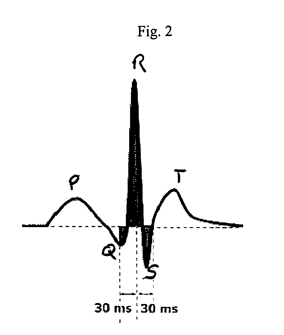 System, software, and method for detection of sleep-disordered breathing using an electrocardiogram