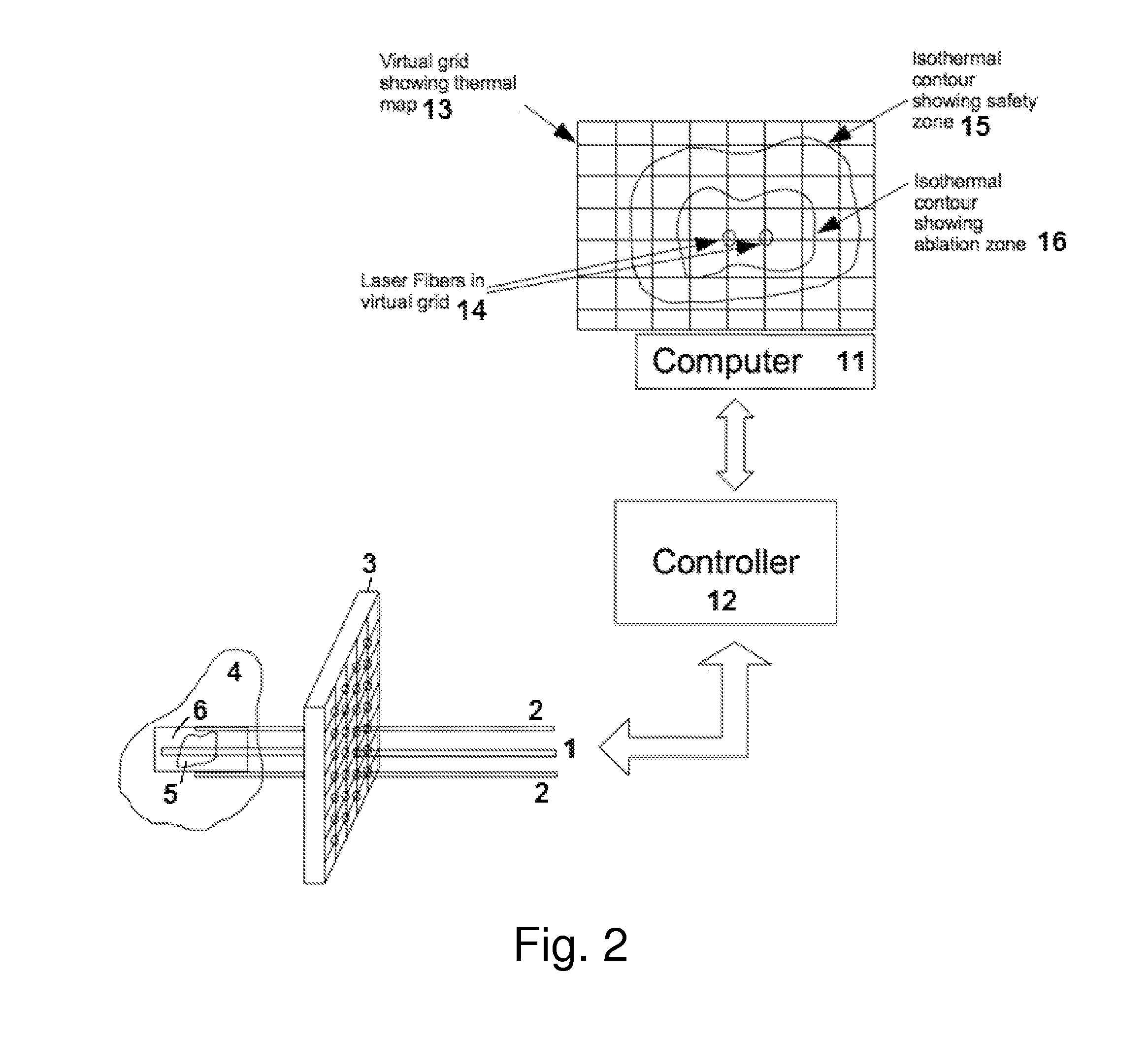 Method and apparatus for laser ablation under ultrasound guidance