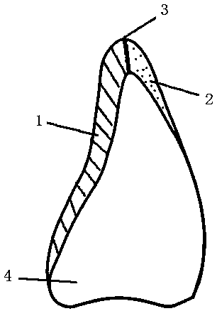 Dental mixed porcelain laminate veneer and manufacturing method