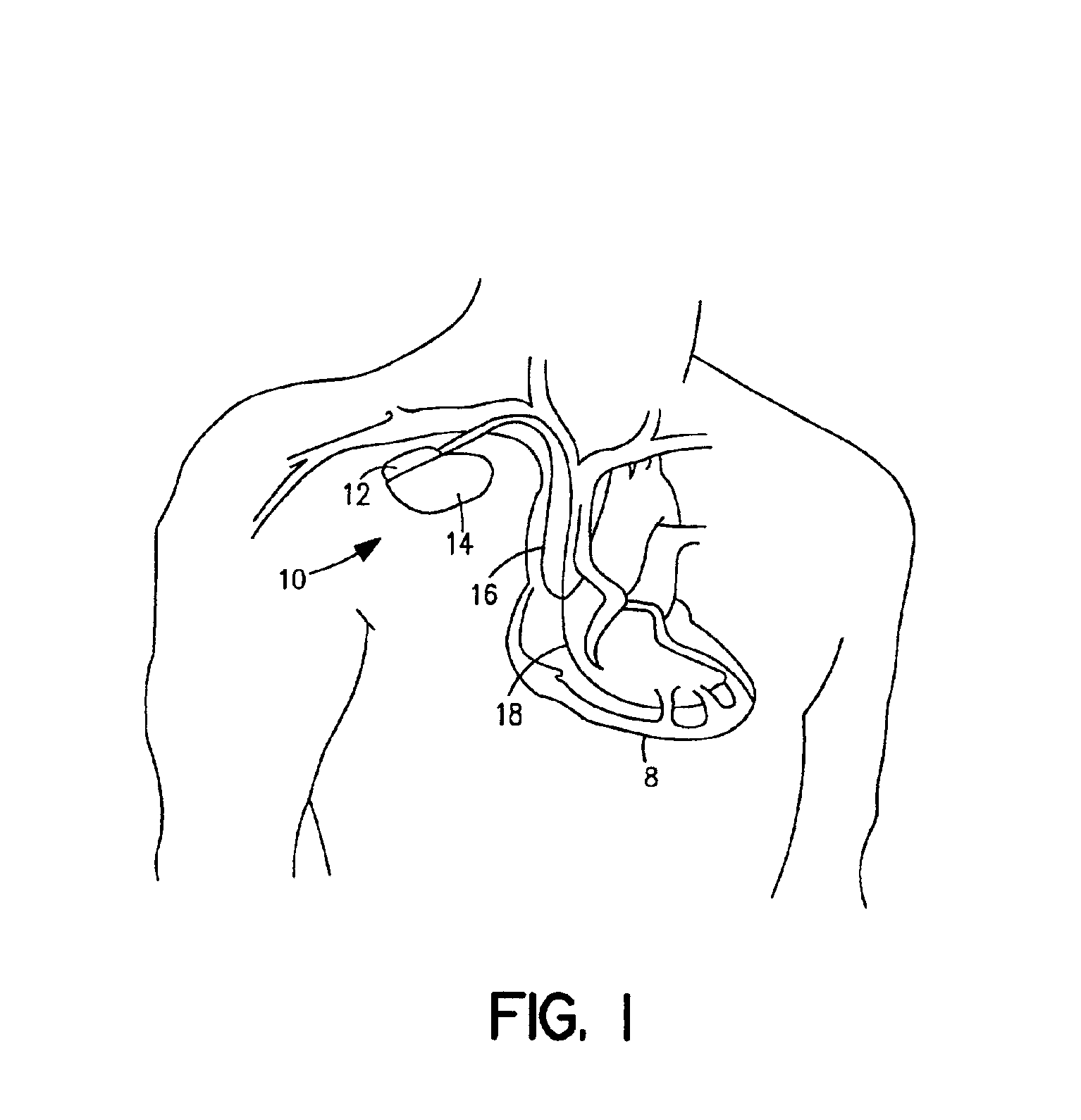 Method and system for transferring and storing data in a medical device with limited storage and memory