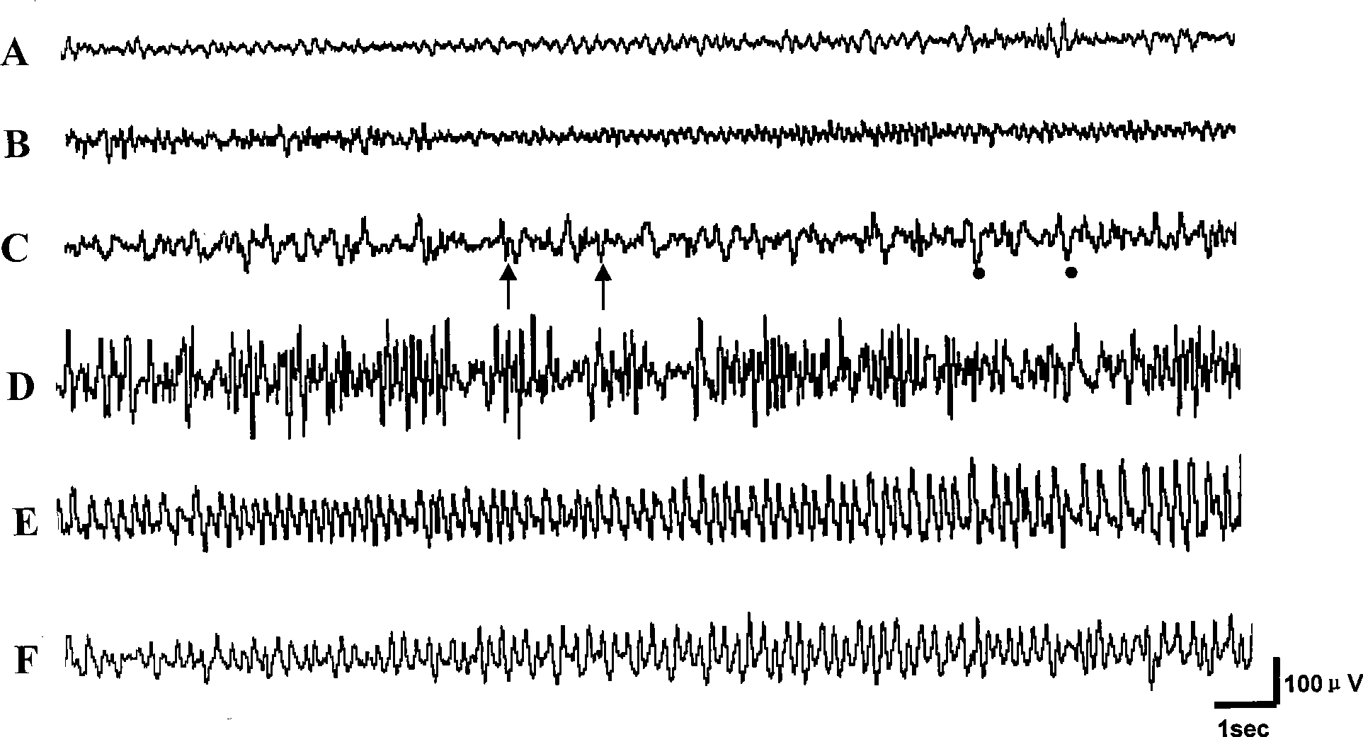 Cyclopenthiazide induced novel epilepsy model