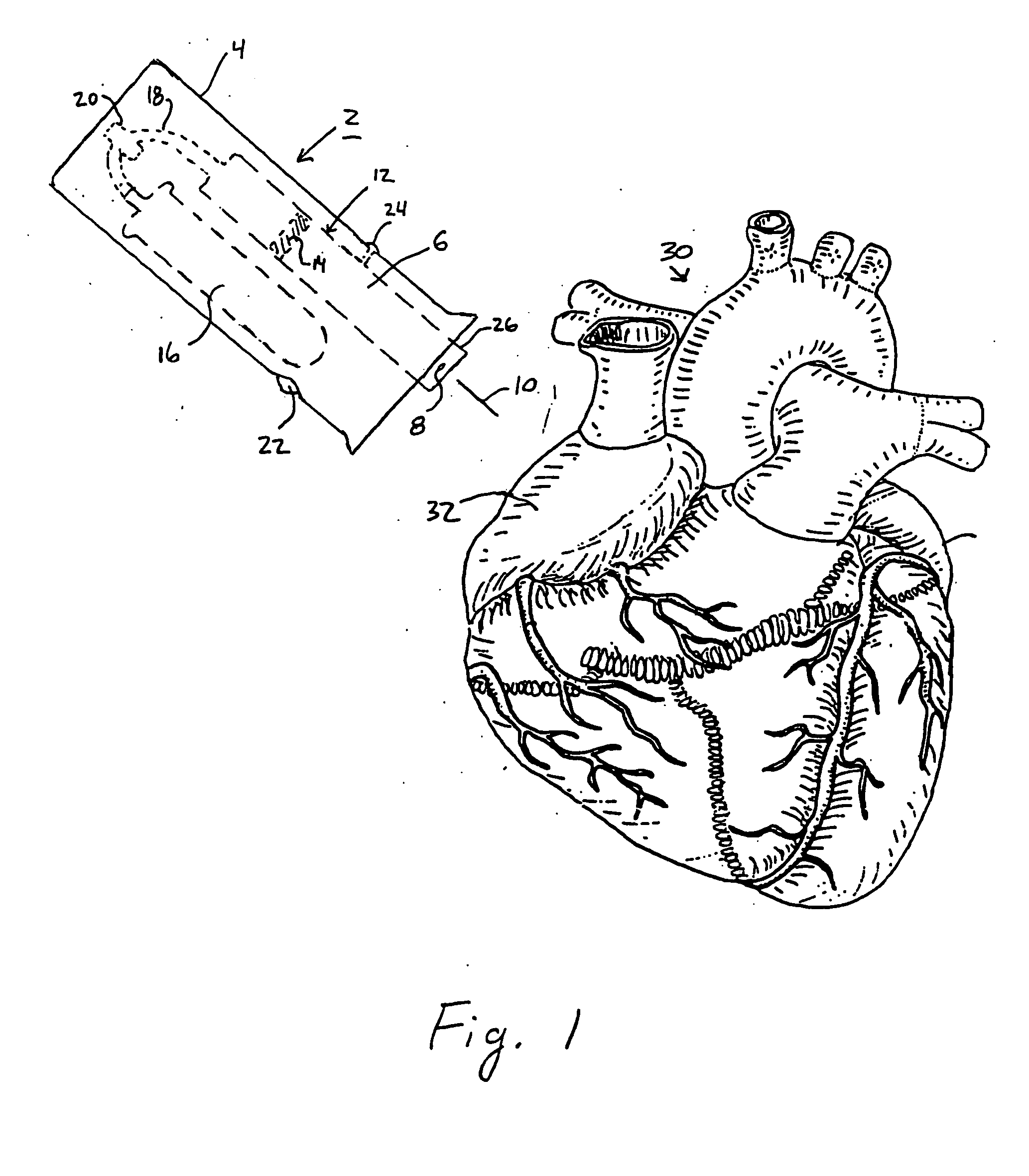 Systems and methods for RF ablation using jet injection of a conductive fluid