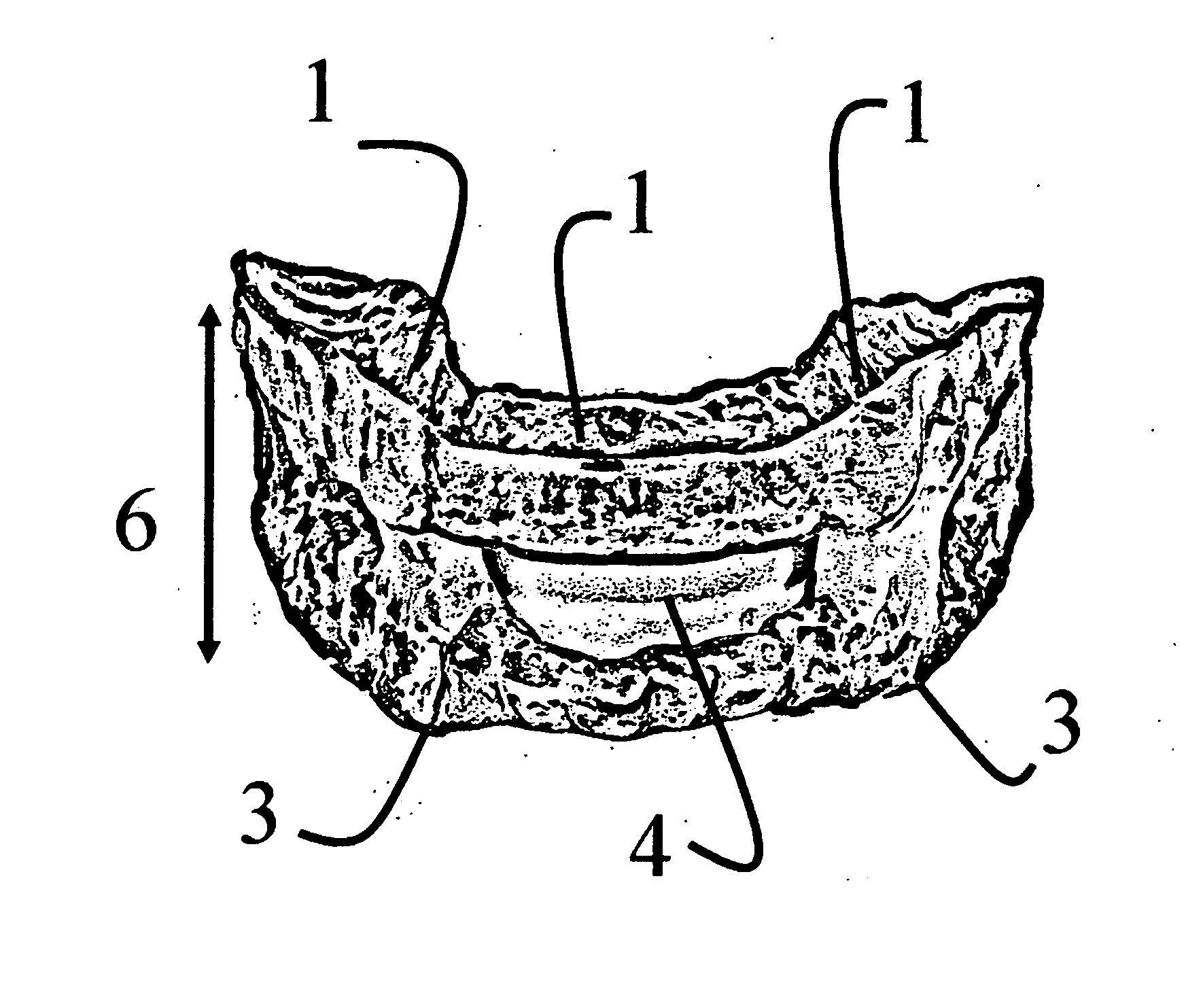 Oral appliance for altitude sickness