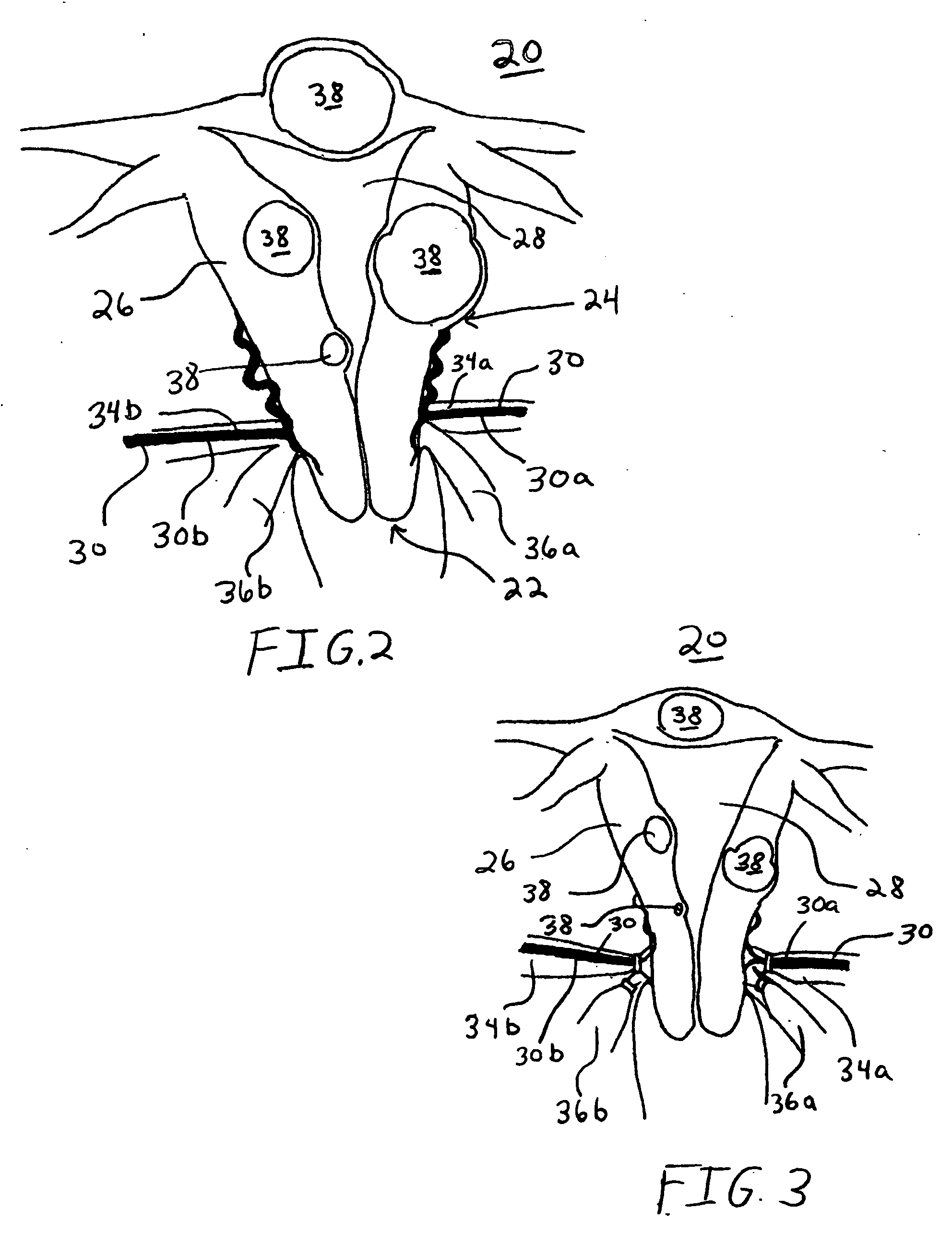 Transvaginal uterine artery occlusion for treatment of uterine leiomyomas