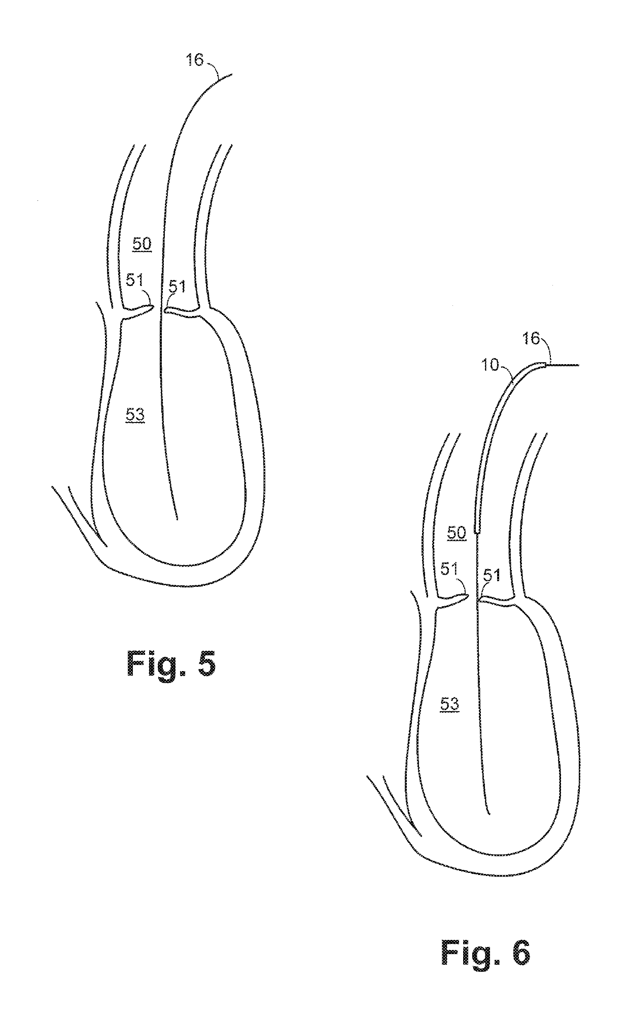 TAVR ventricular catheter