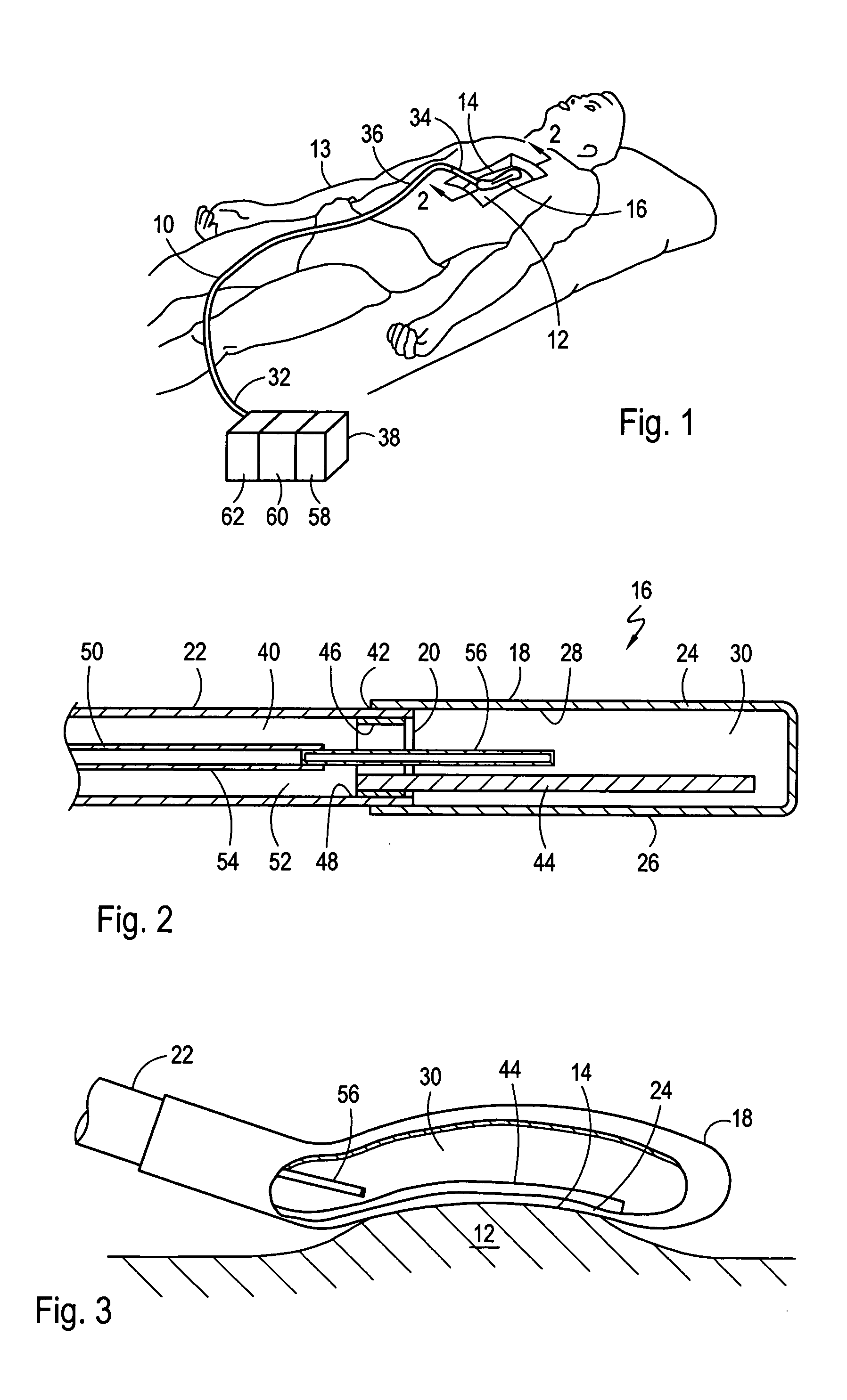 Reshapeable tip for a cryoprobe