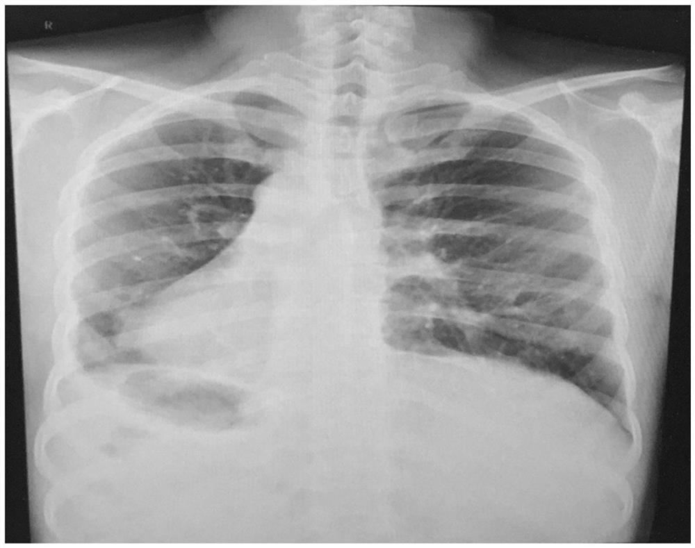 An autosomal recessive karagener syndrome mutant gene and its application