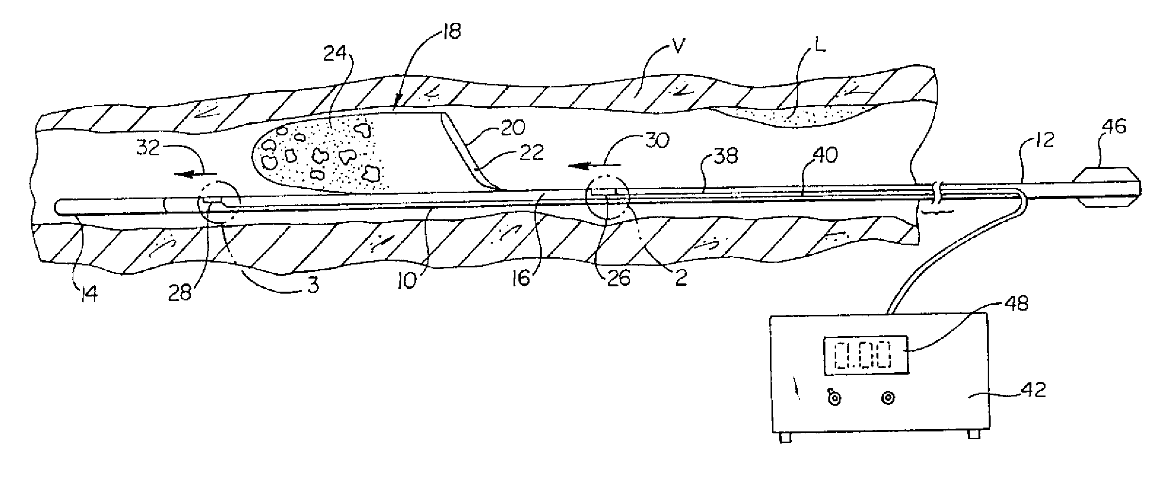 Intravascular filter monitoring