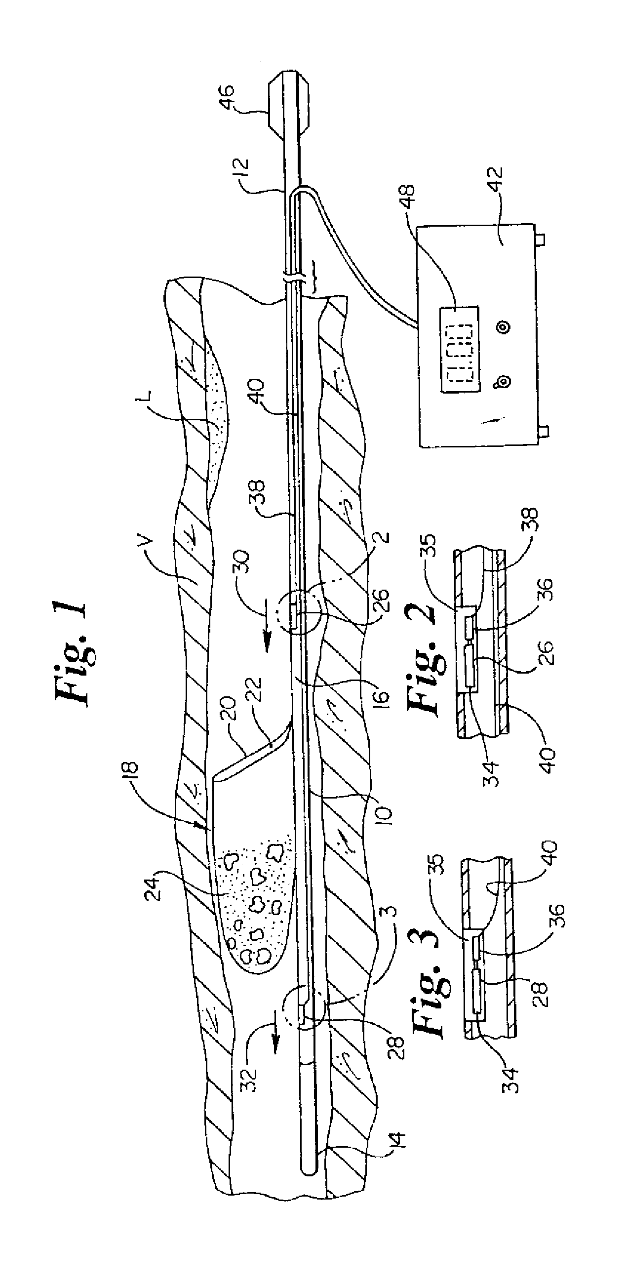 Intravascular filter monitoring