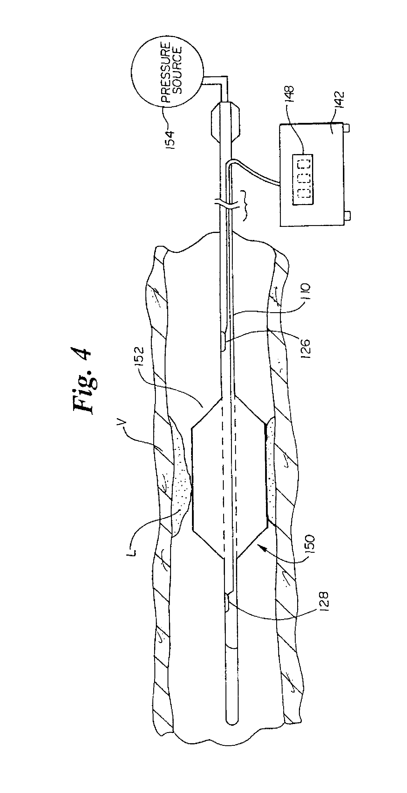 Intravascular filter monitoring