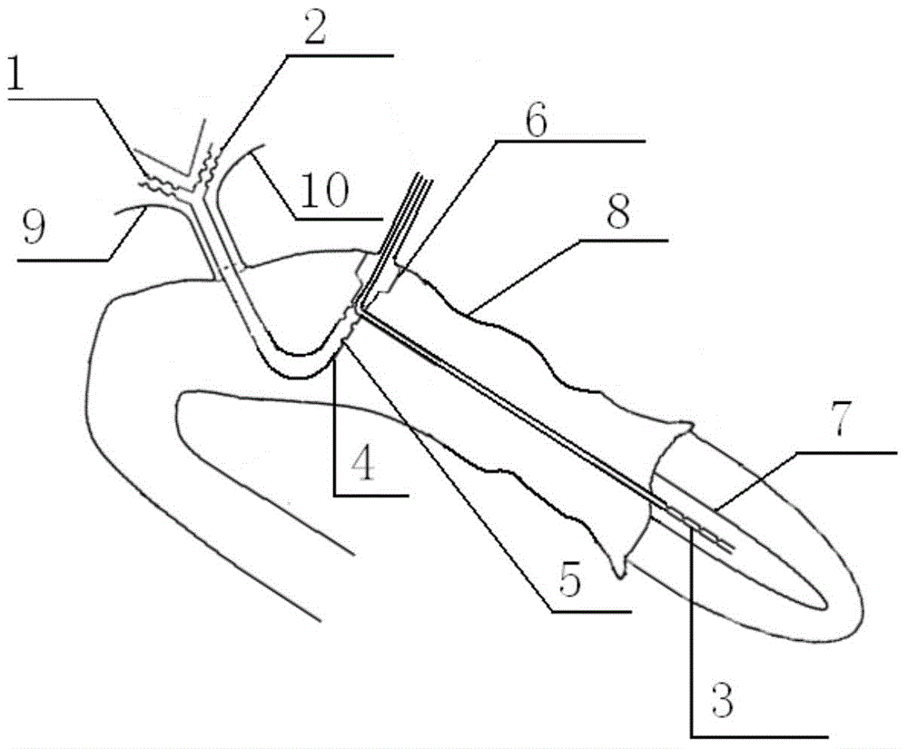 Fistulization decompression tube for biliopancreatic supporting drainage jejunum