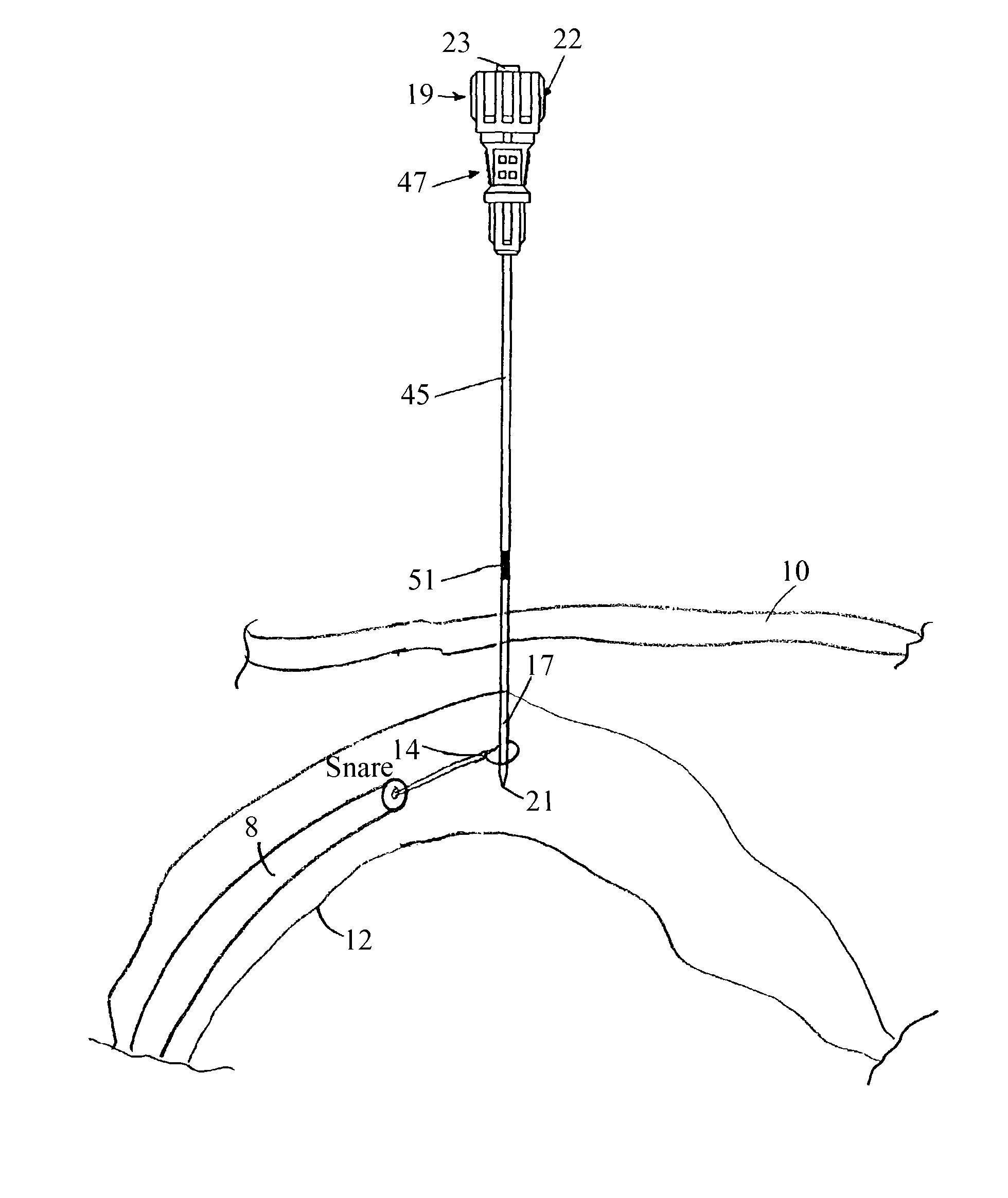 Method for implanting a percutaneous endoscopic gastrostomy/jejunostomy tube in a patient and access needle for use in said method