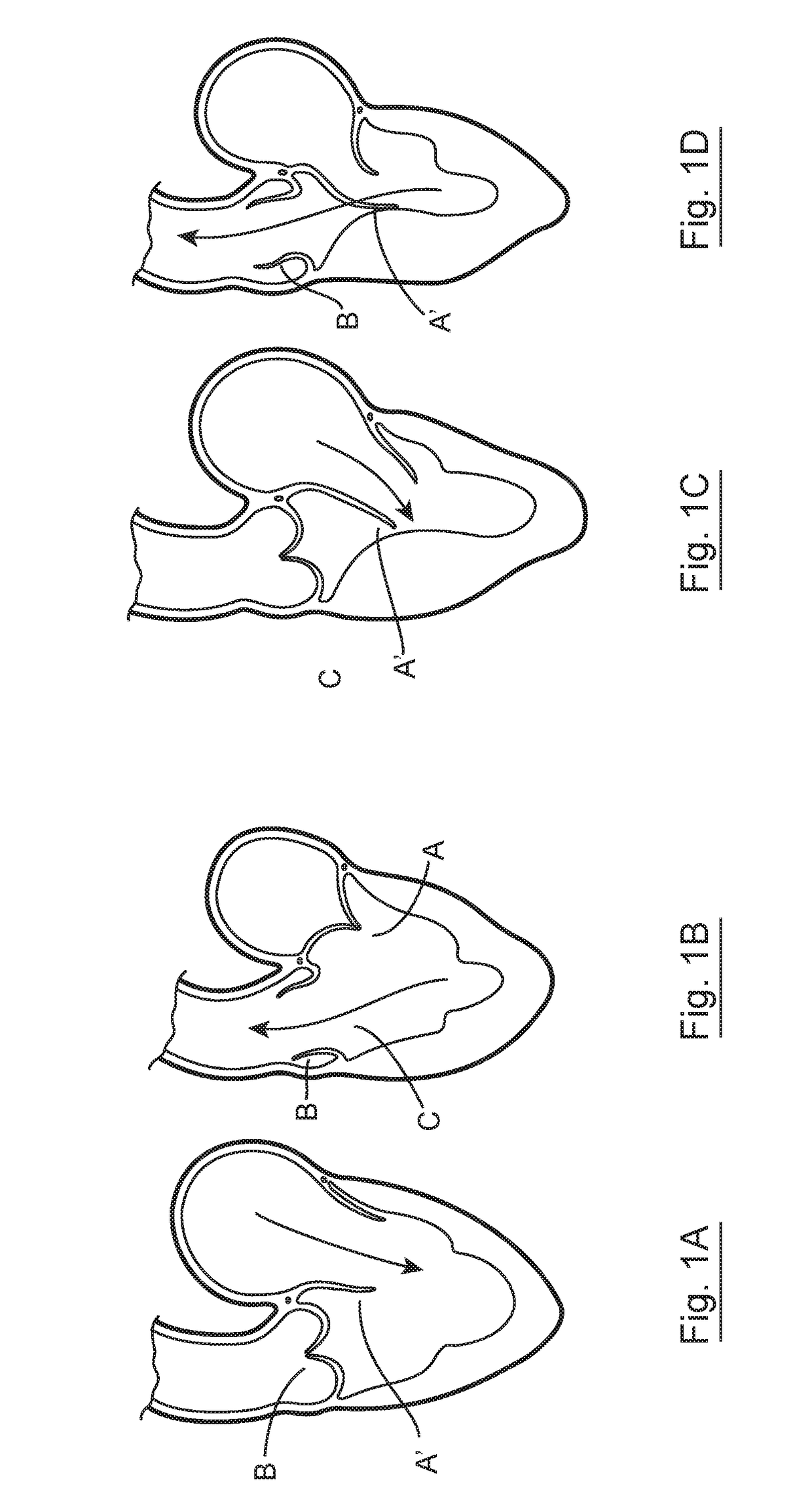 Implantable intracardiac device and methods thereof