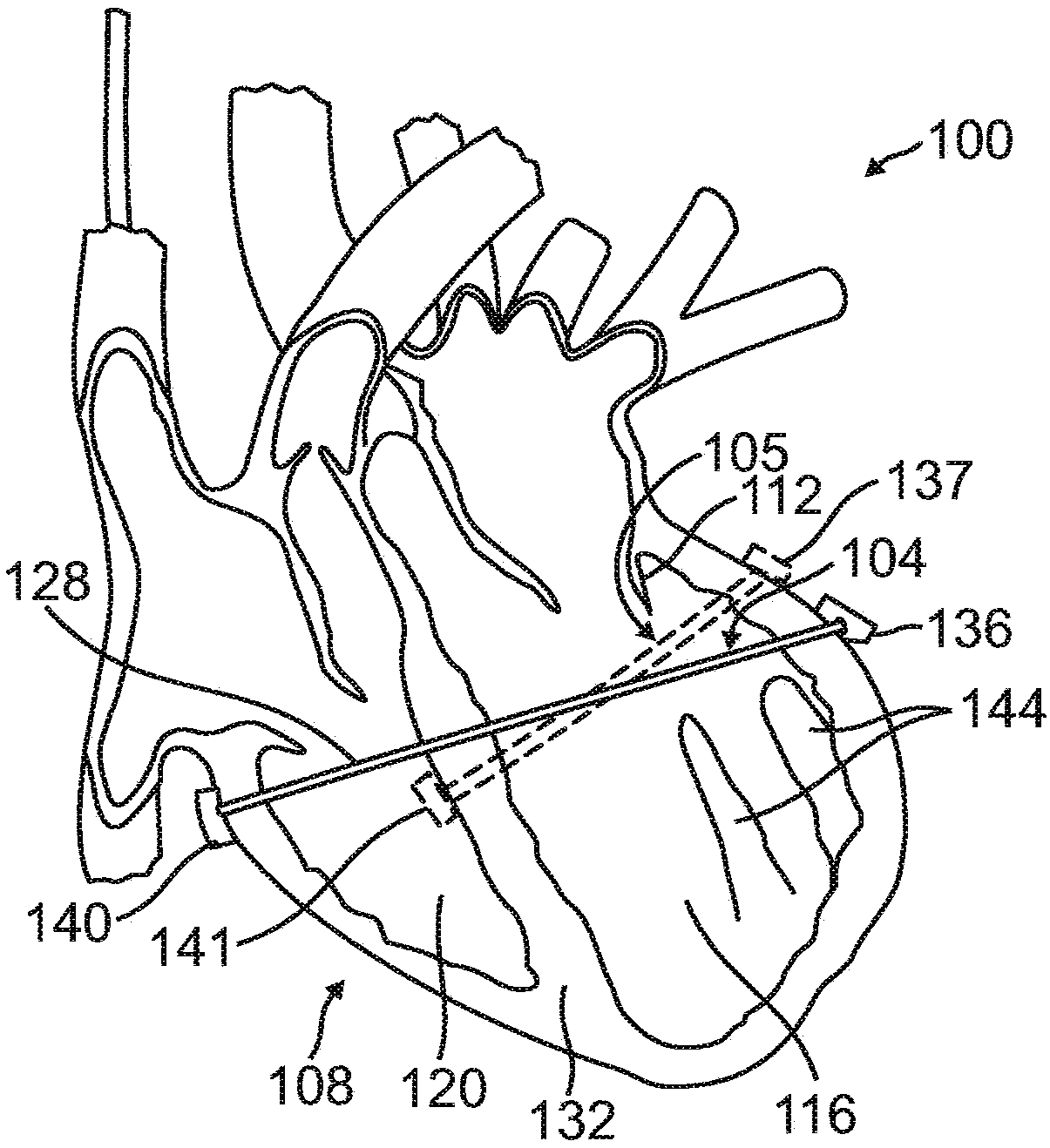 Systems and devices for setting anchor