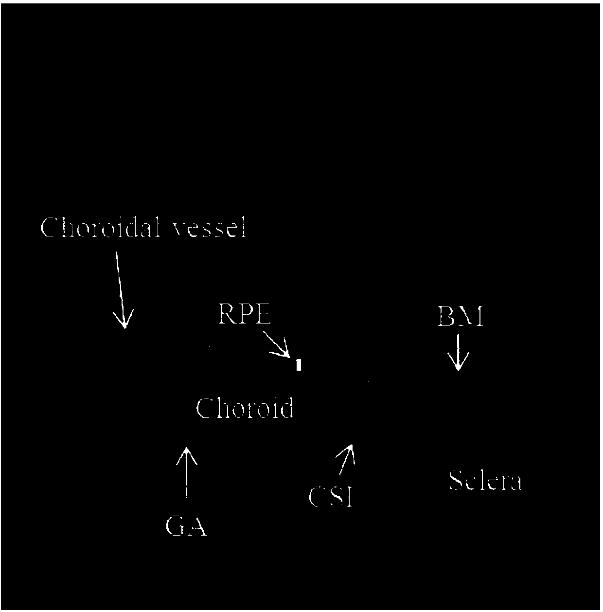 Map-like atrophy projected image generation method based on SD-OCT retina images