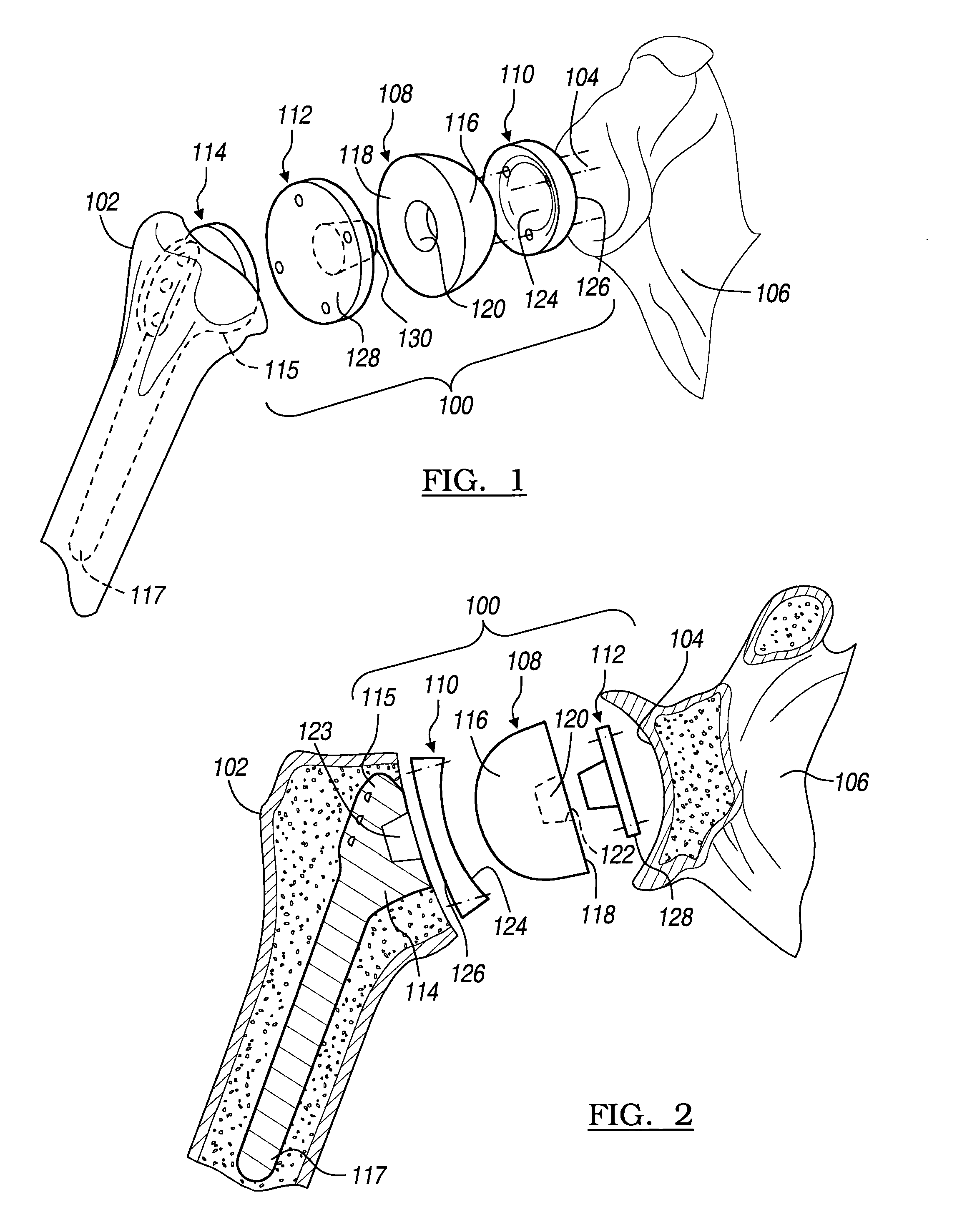 Shoulder implant assembly