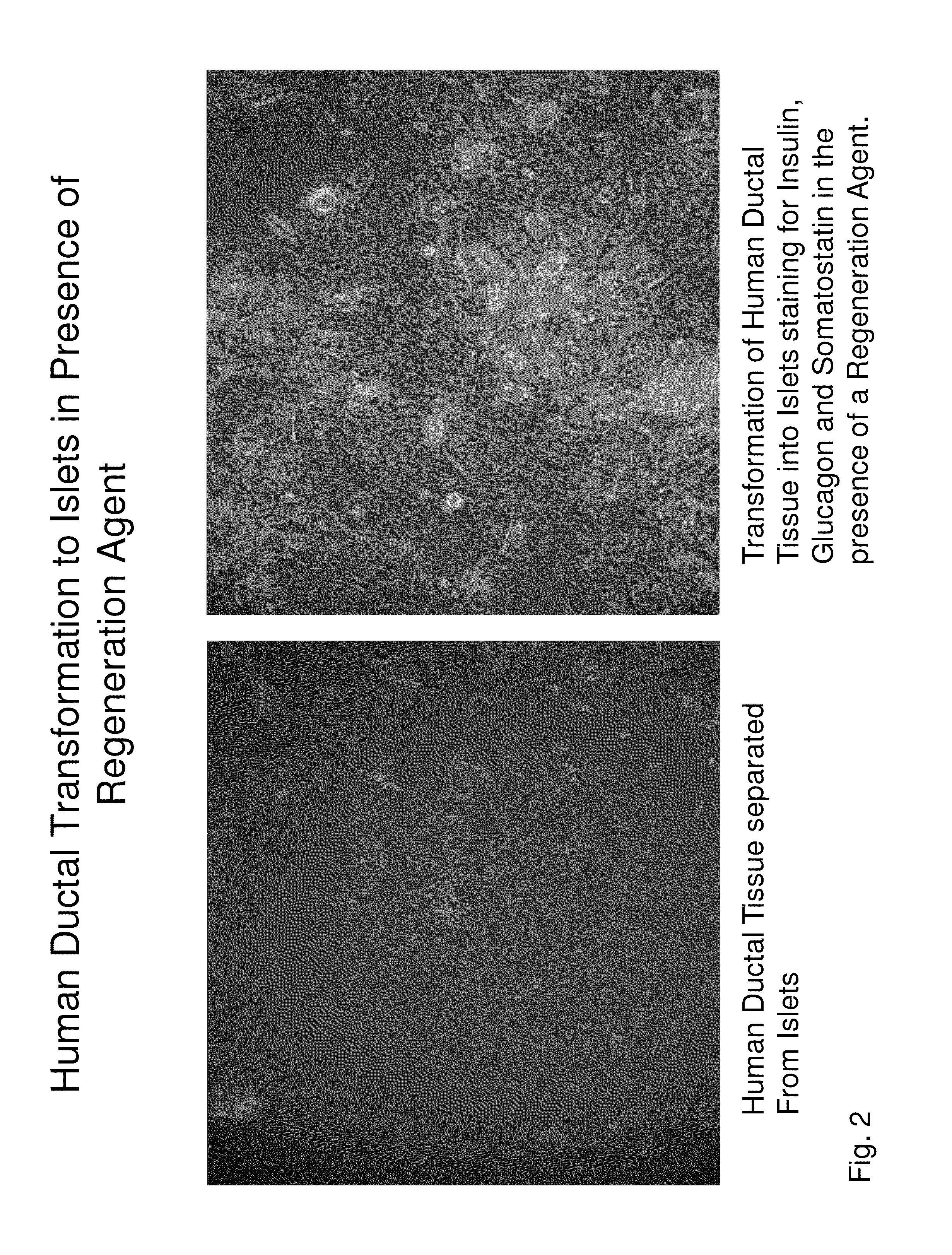 Insulin independence among patients with diabetes utilizing a ppi in combination with an immune tolerance agent