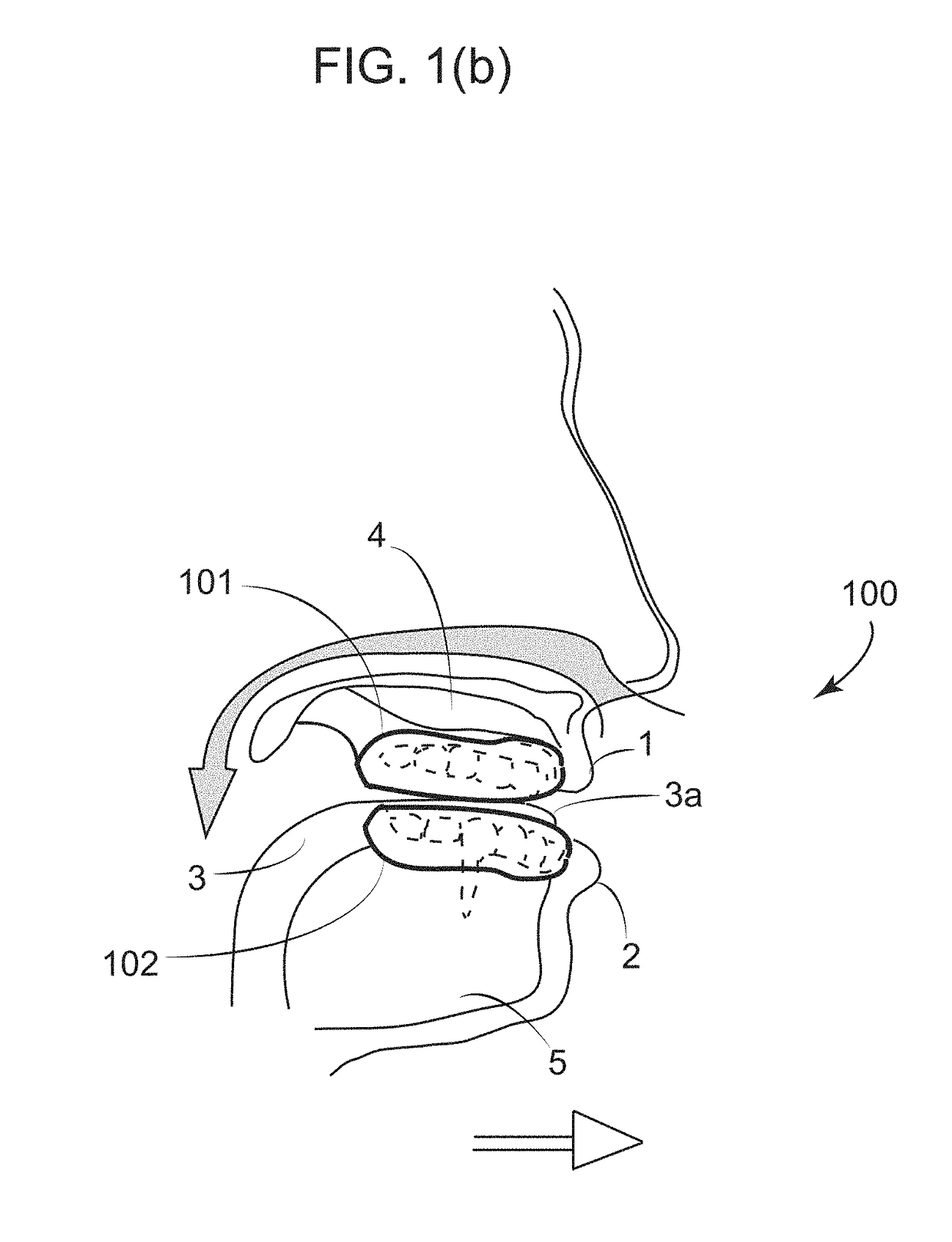 Dental Appliance