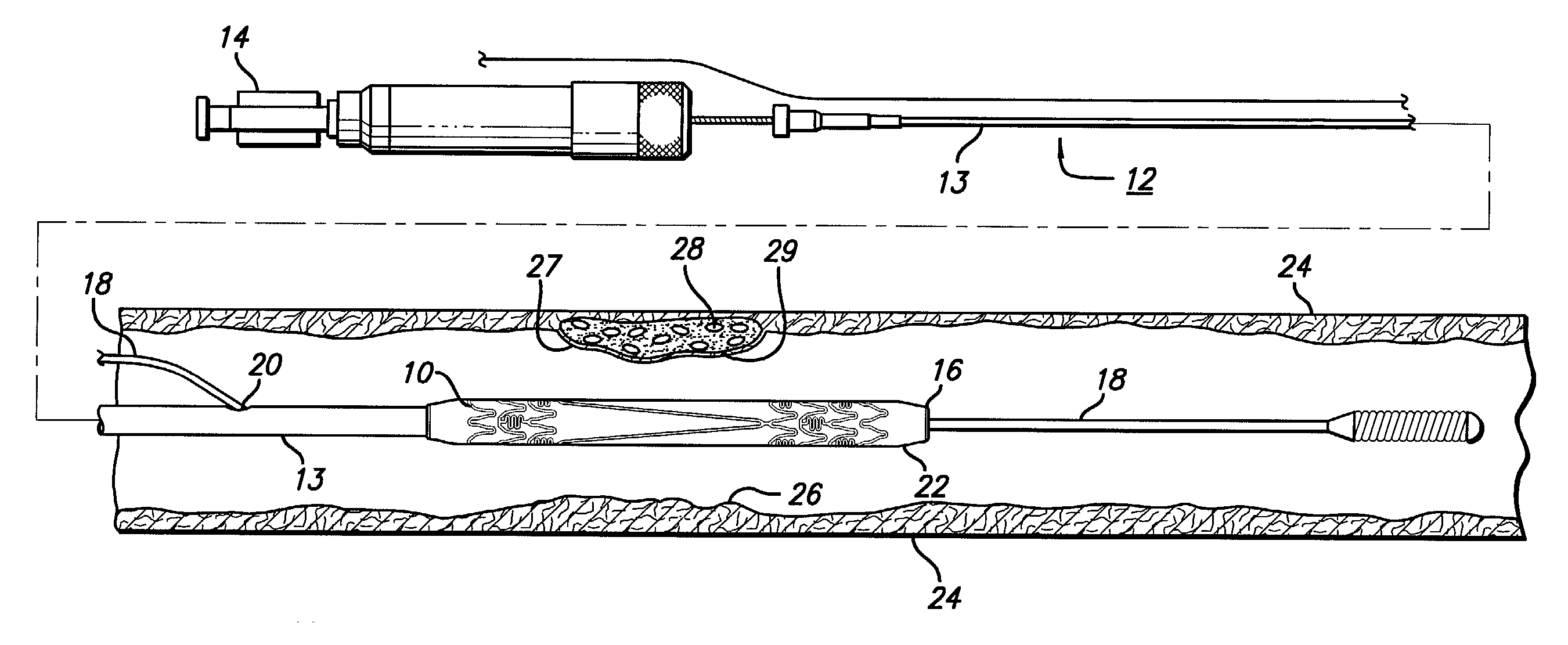 Intravascular stent and method of use