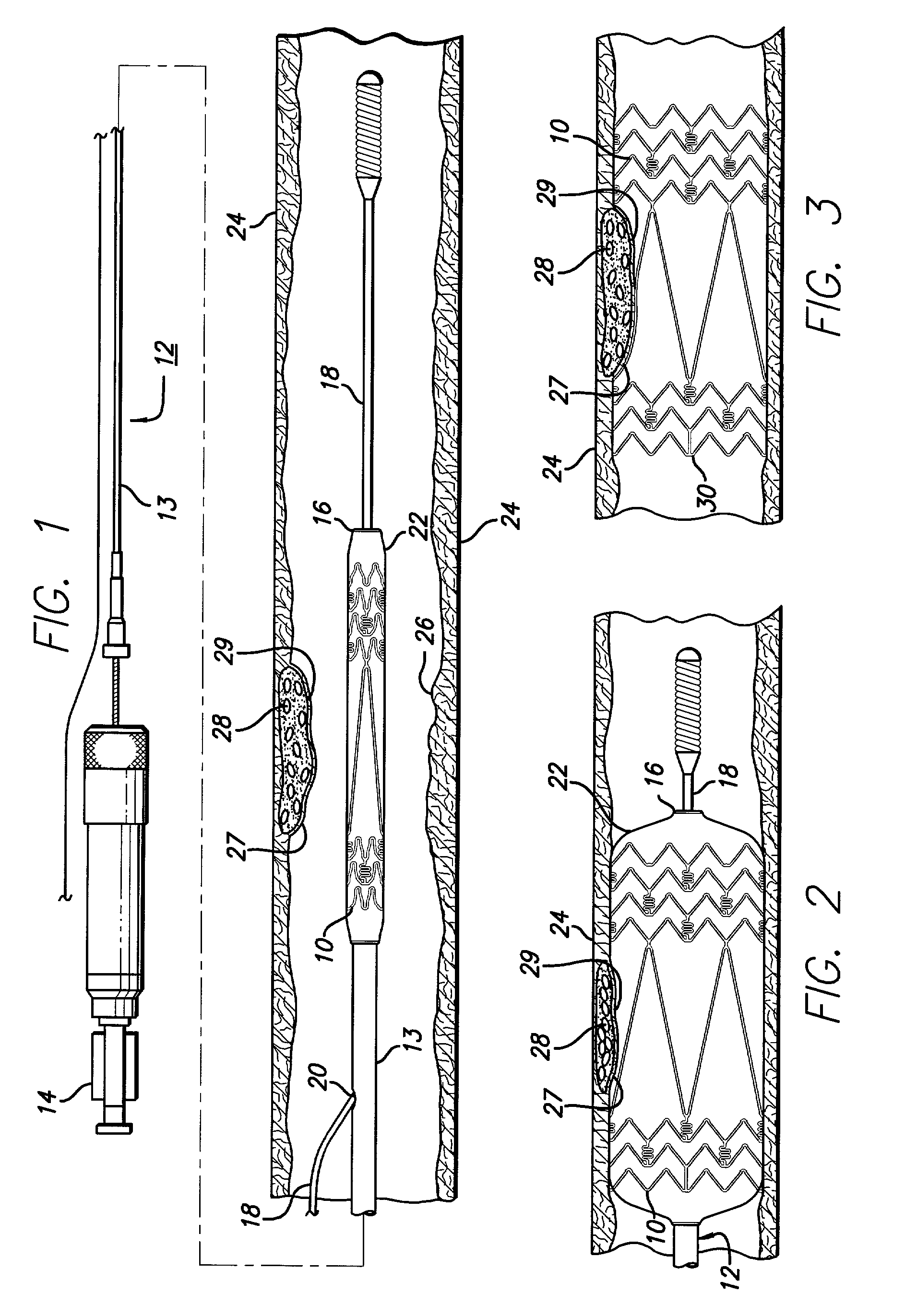 Intravascular stent and method of use