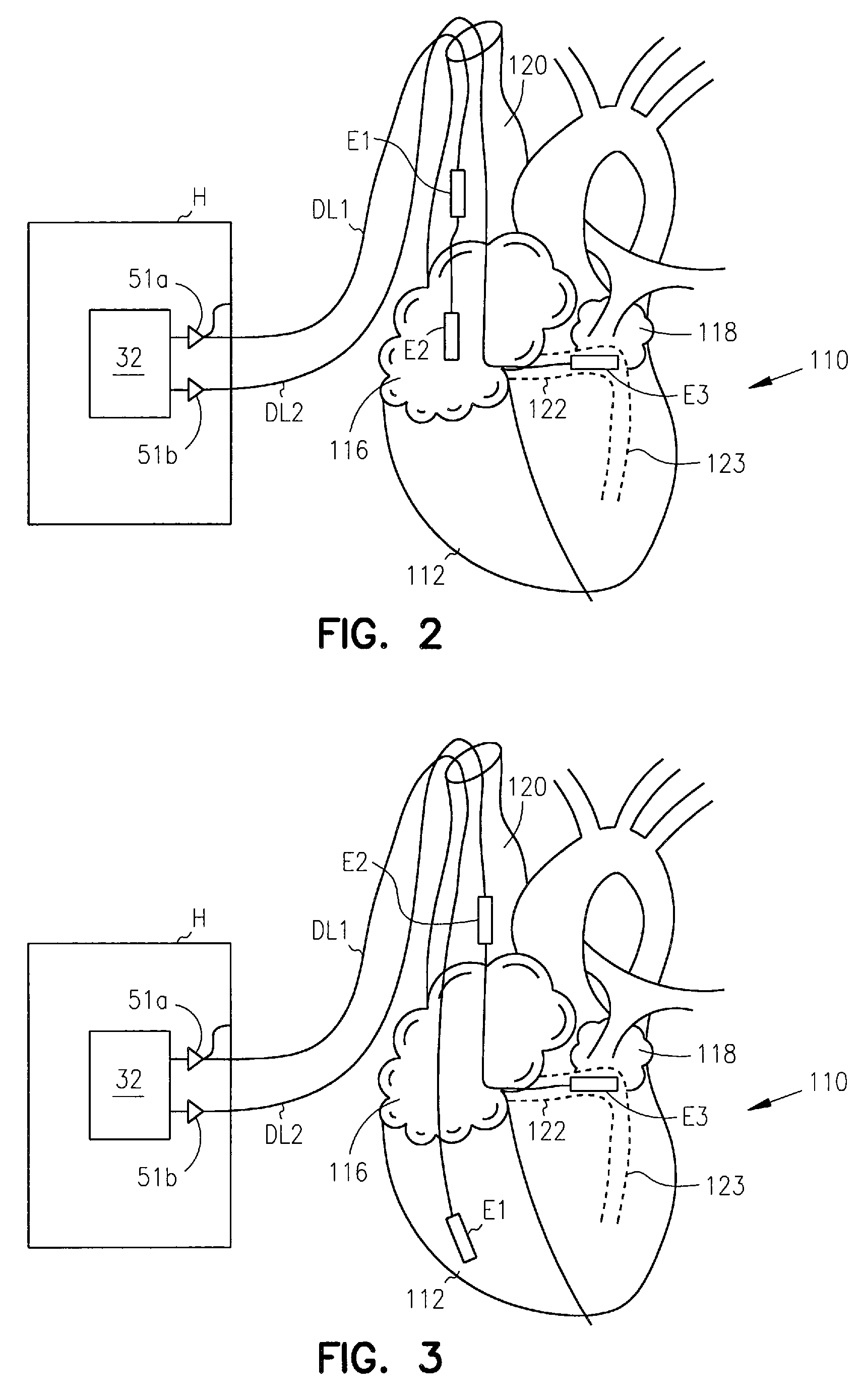 Method and apparatus for termination of cardiac tachyarrhythmias