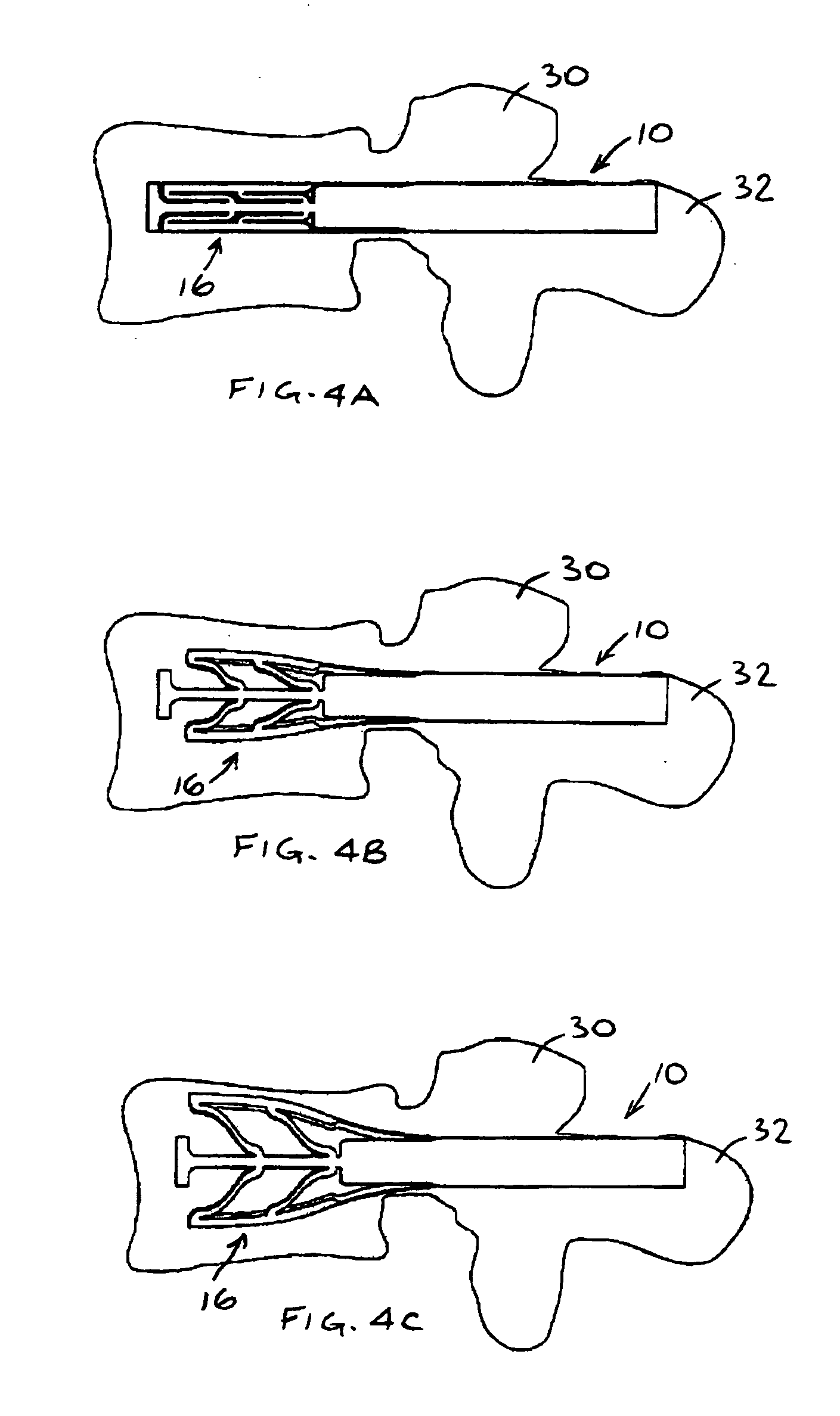 Expandable bone device