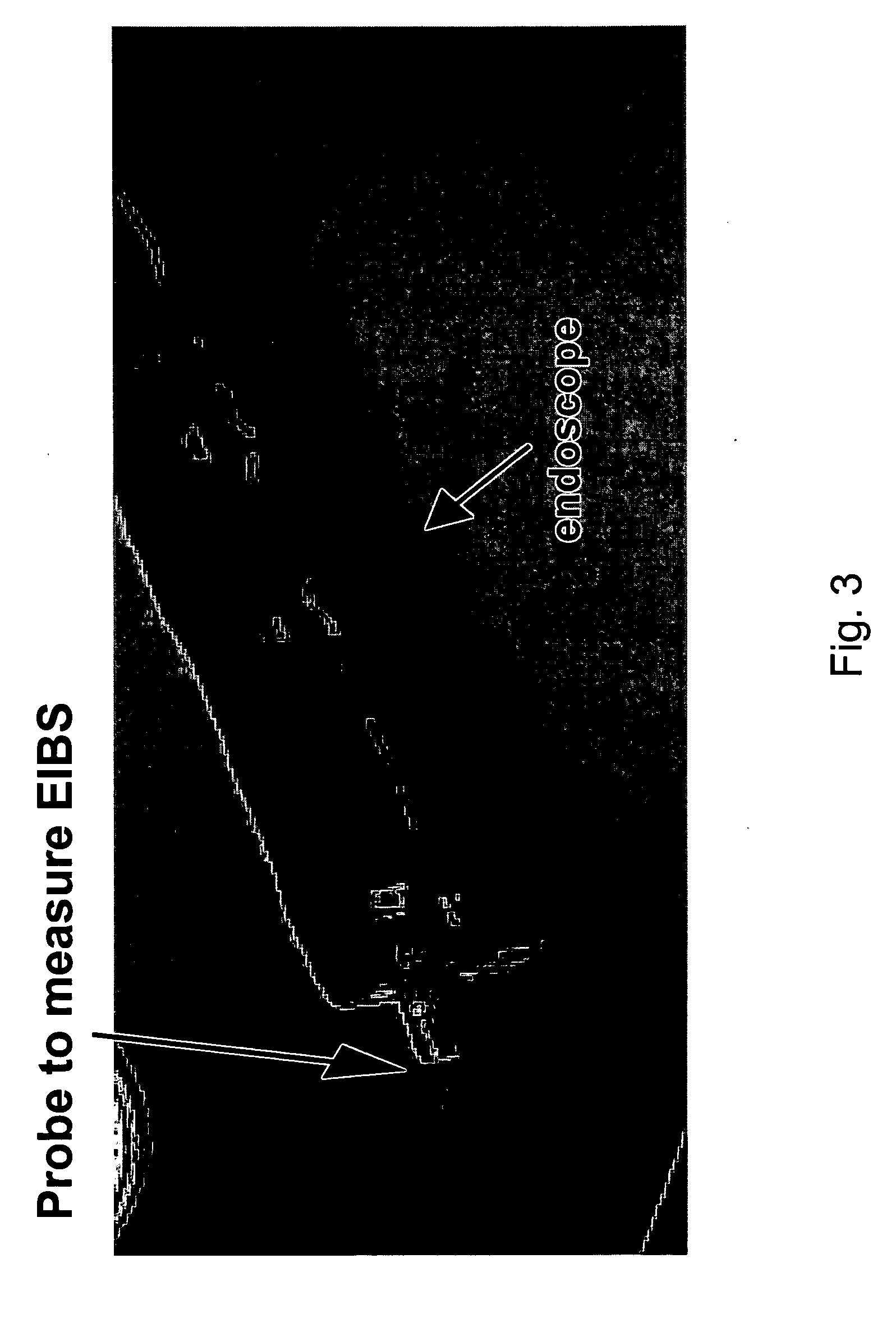 Method of recognizing abnormal tissue using the detection of early increase in microvascular blood content