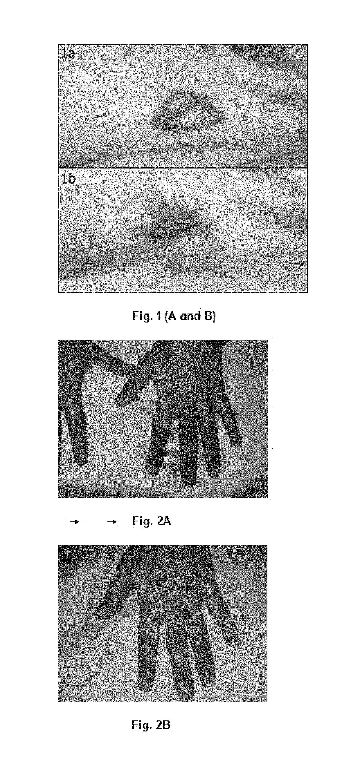 Compositions for the treatment of ischemic ulcers and stretch marks