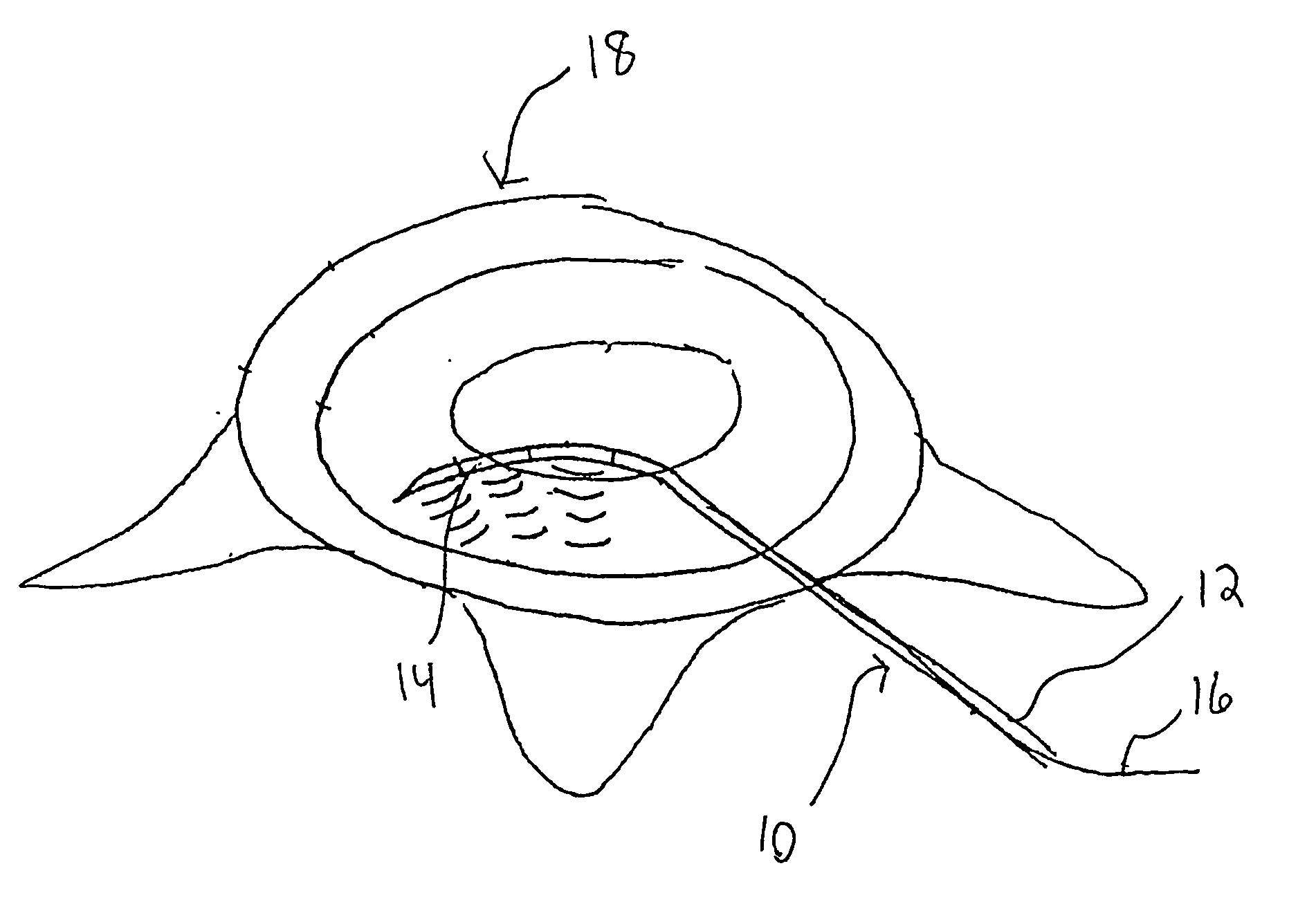 Ultrasound device for treatment of intervertebral disc