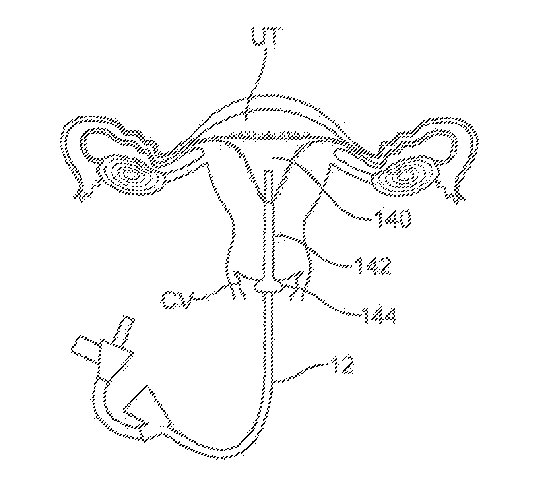 Cyrogenic treatment systems