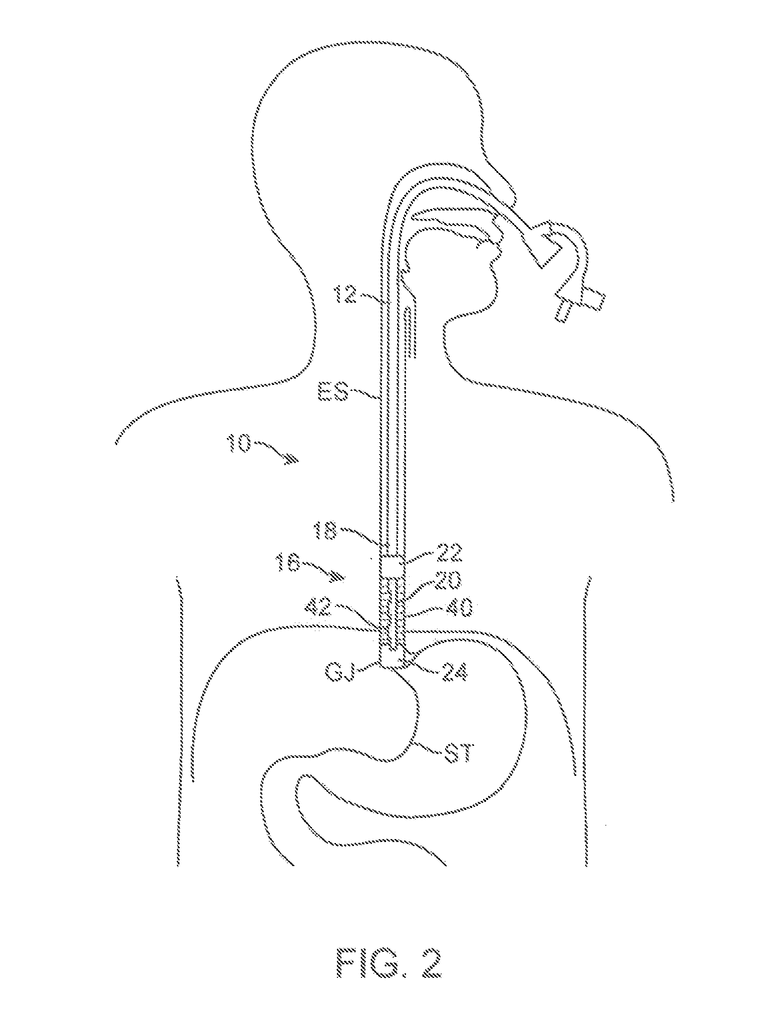 Cyrogenic treatment systems